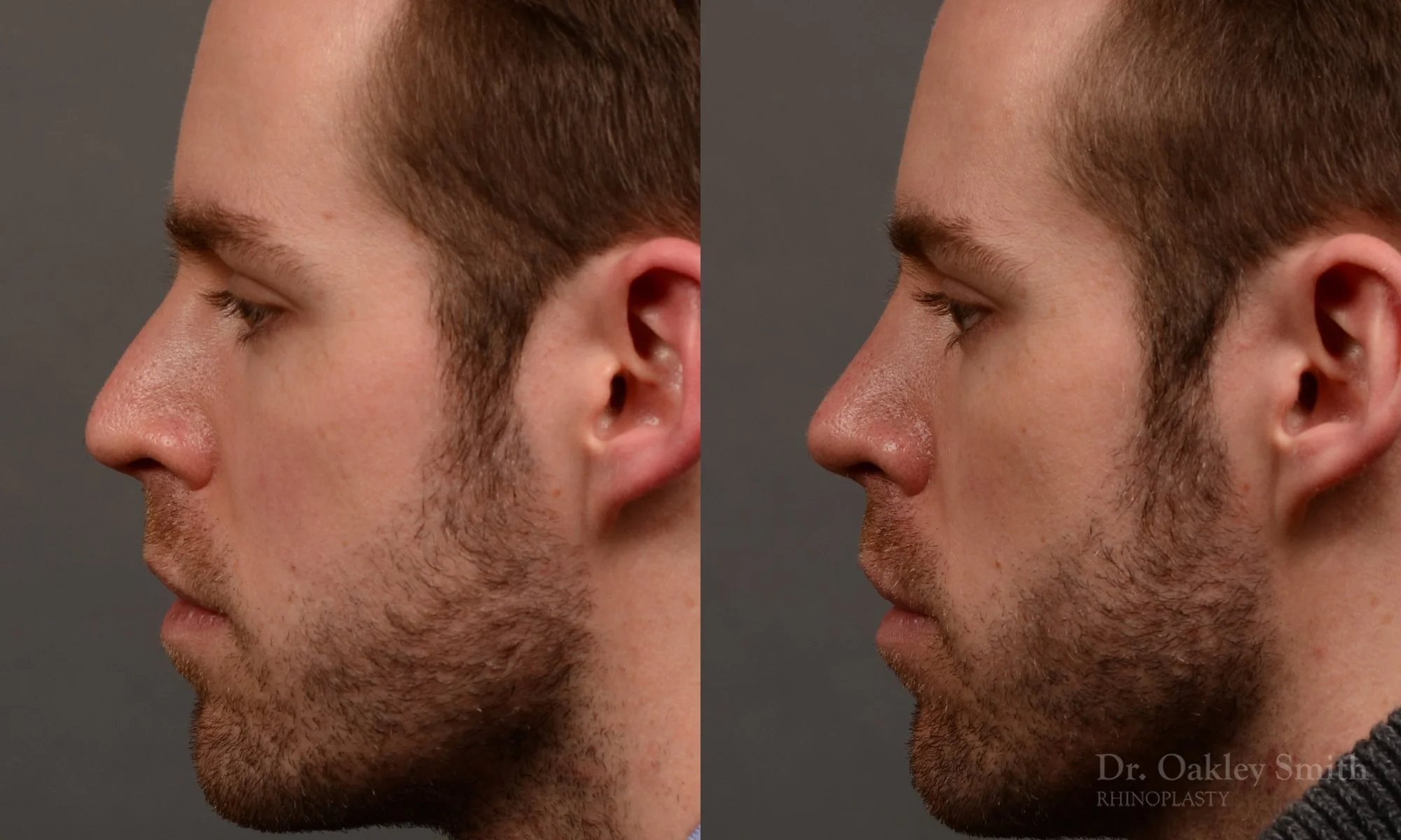 337E-rhinoplasty-dr-oakley-smith-toronto-nose-job.jpg