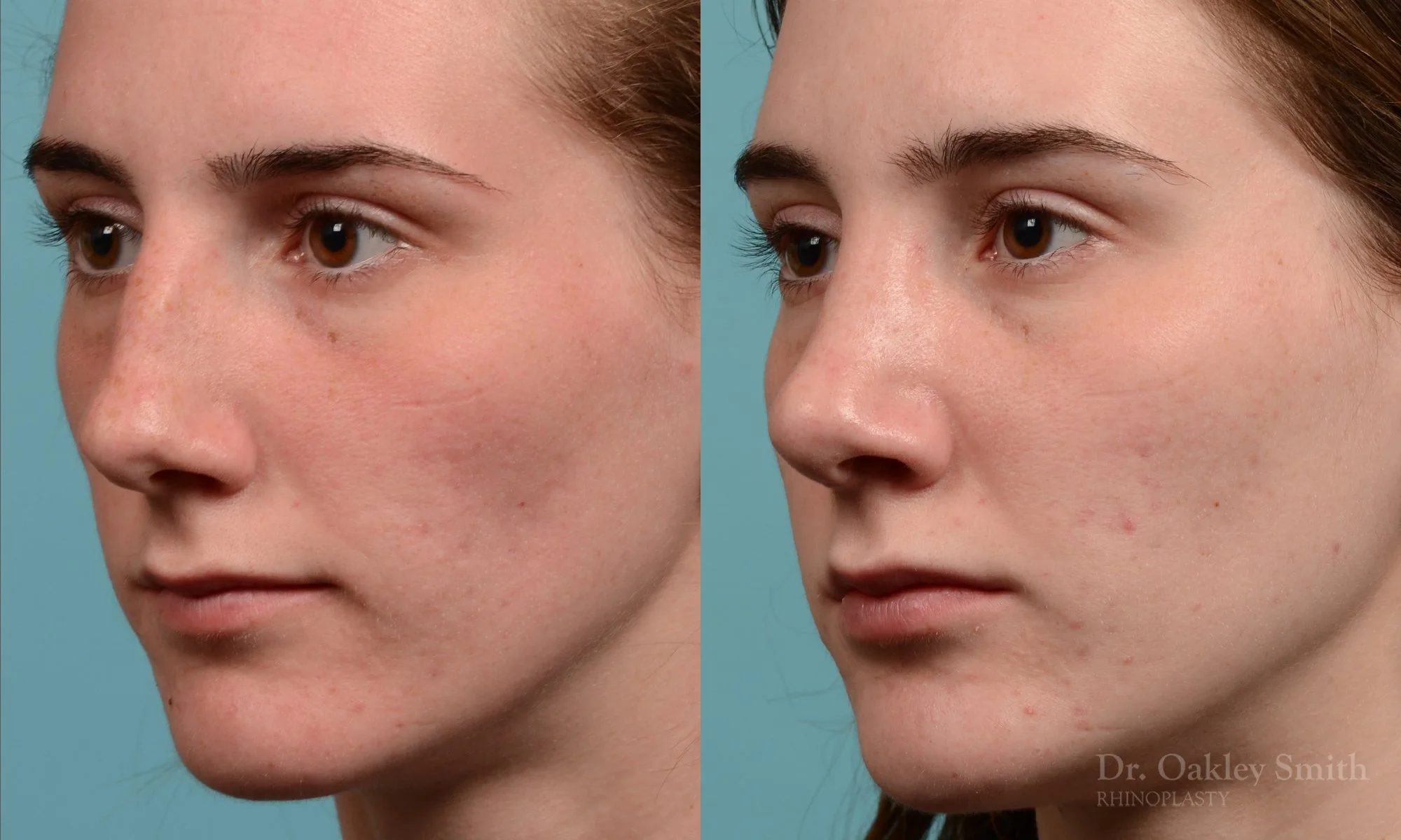 248D-rhinoplasty-dr-oakley-smith-toronto-nose-job.jpg