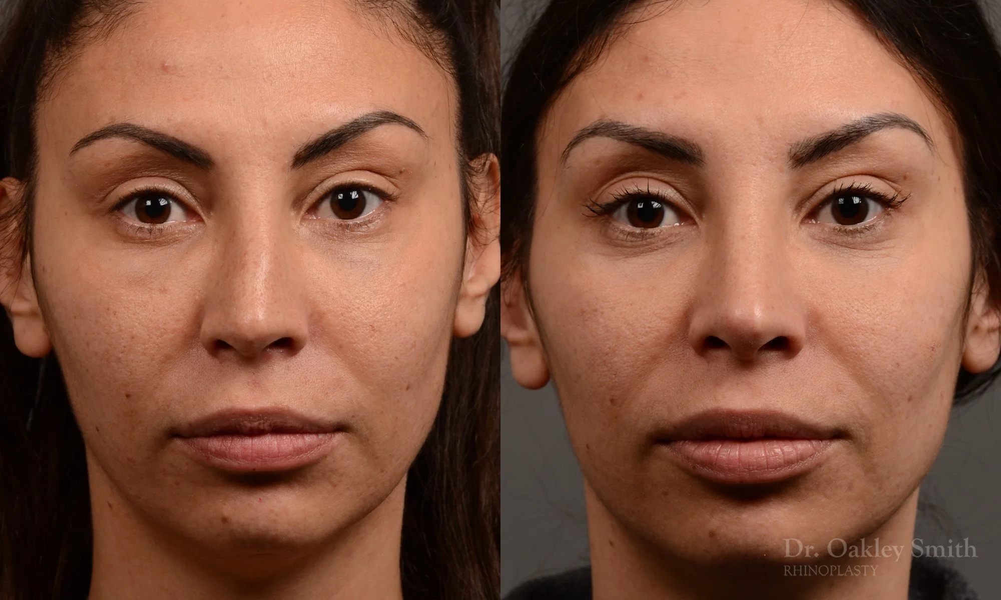 279: Female, Ethnic Rhinoplasty, Thick Skin, Dorsal Hump, Tip Refinement, Crooked