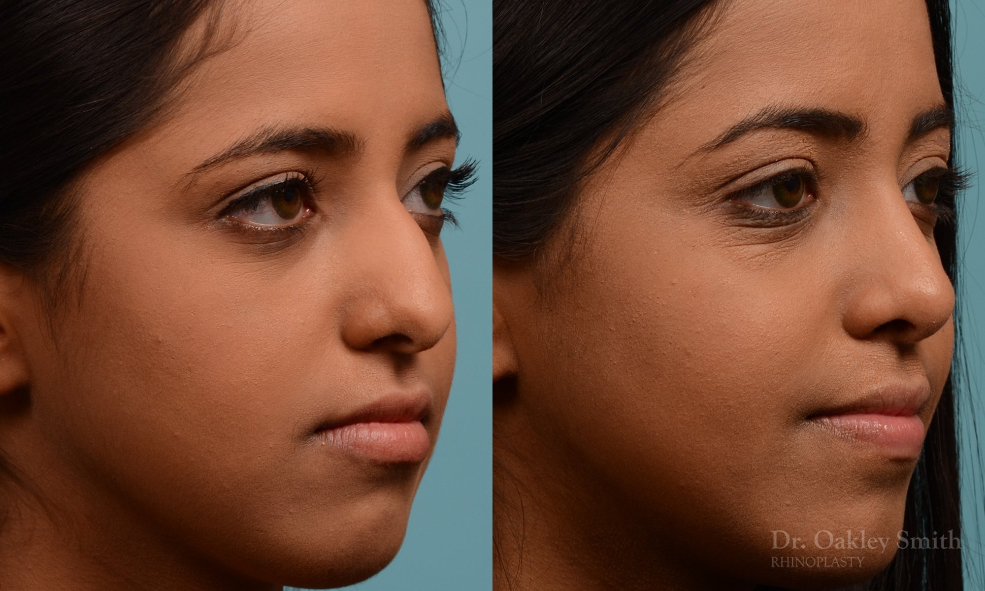 285B-rhinoplasty-dr-oakley-smith-toronto-nose-job.jpg