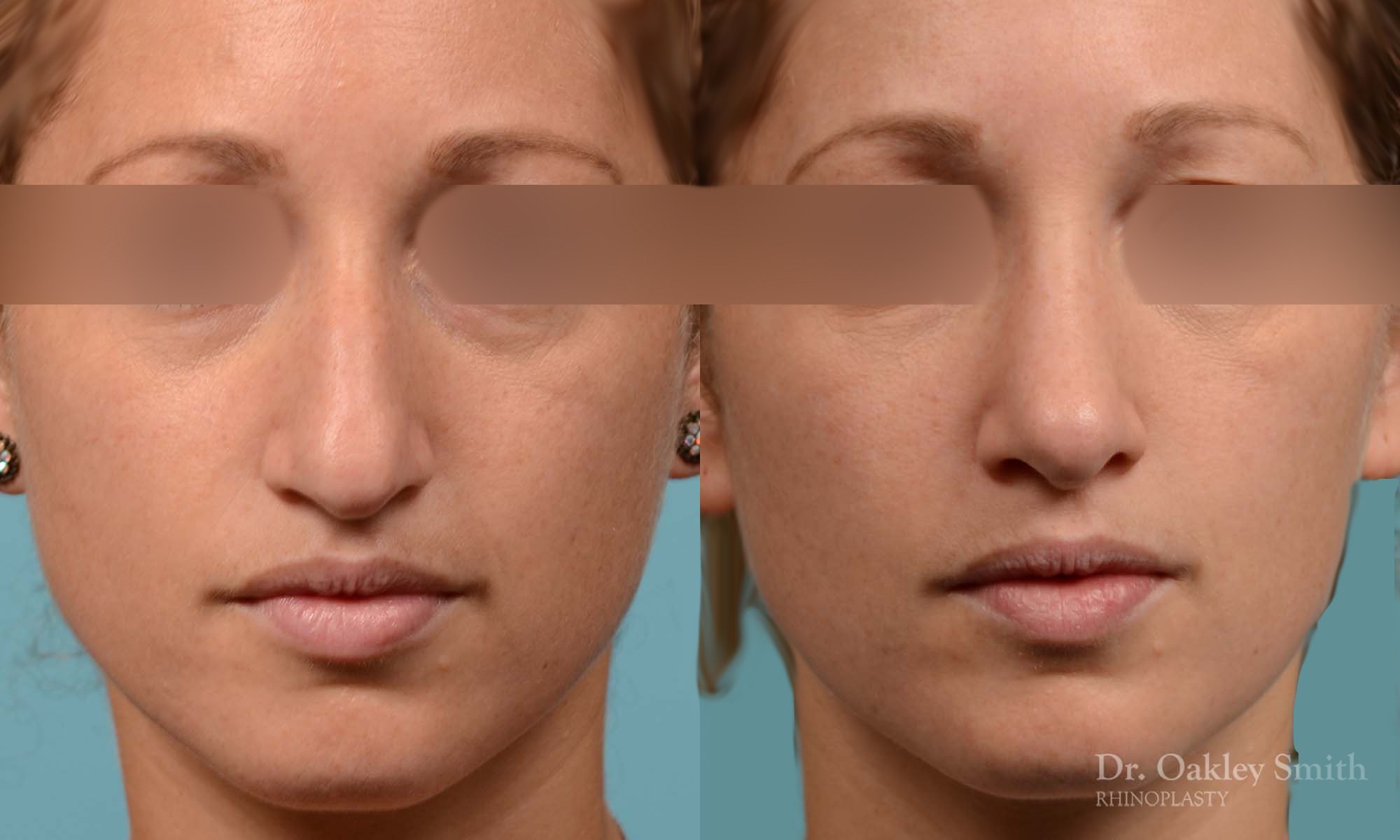 255A-rhinoplasty-dr-oakley-smith-toronto-female-nose-job-1.jpg