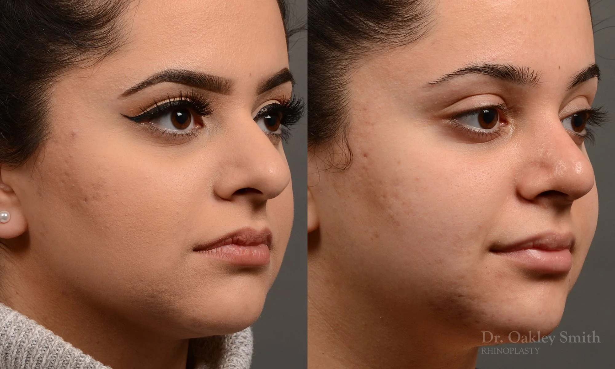 304B-rhinoplasty-dr-oakley-smith-toronto-nose-job.jpg