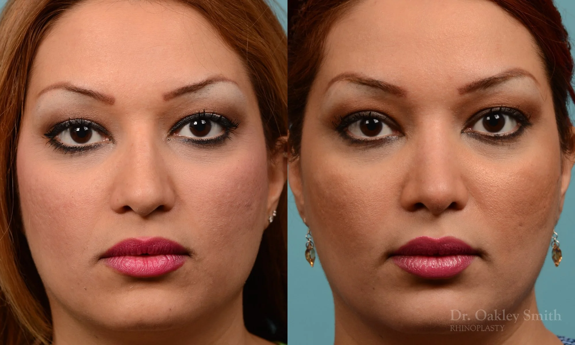 260A-rhinoplasty-dr-oakley-smith-toronto-nose-job.jpg