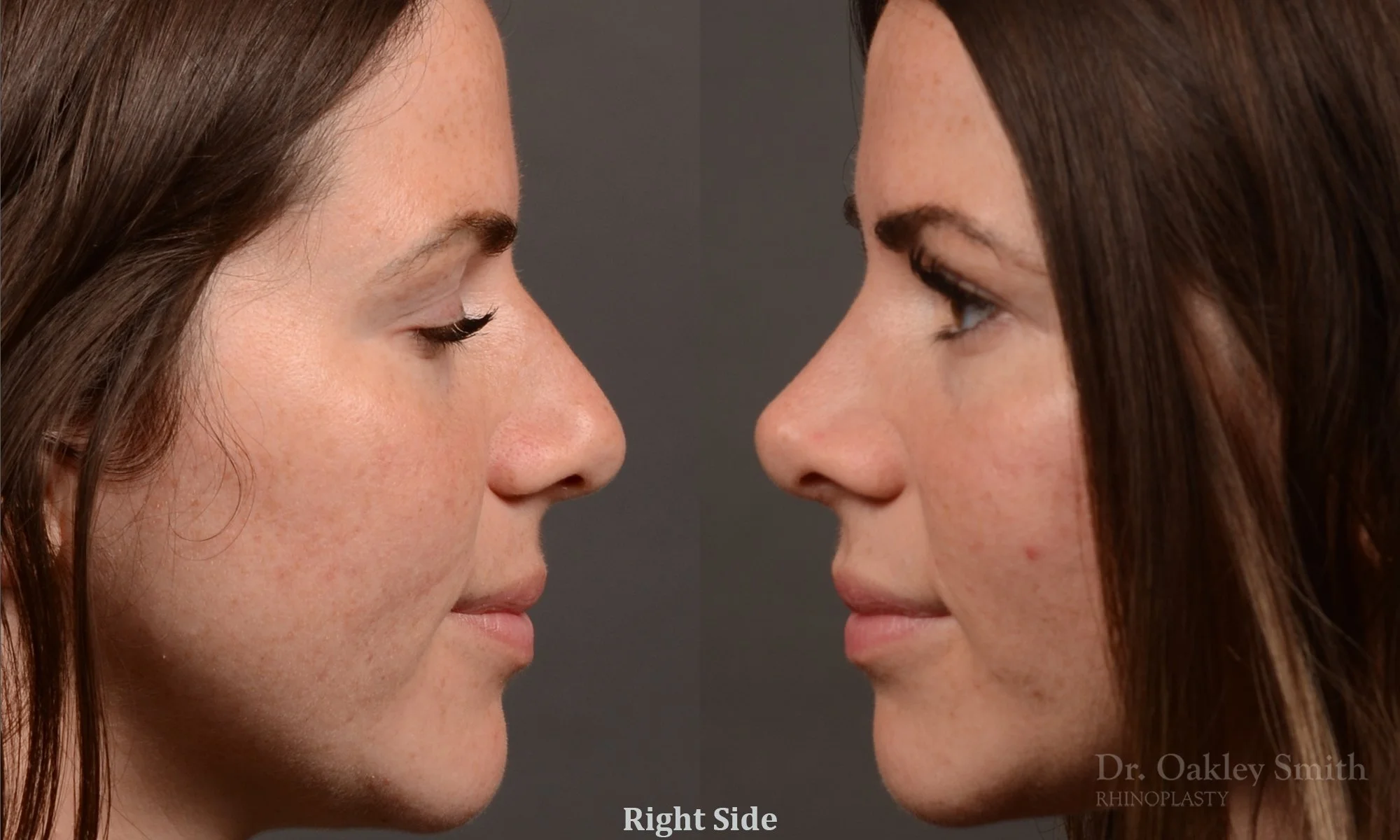 481: Female, Primary  Rhinoplasty, Normal Skin, Bridge Work, Tip Work