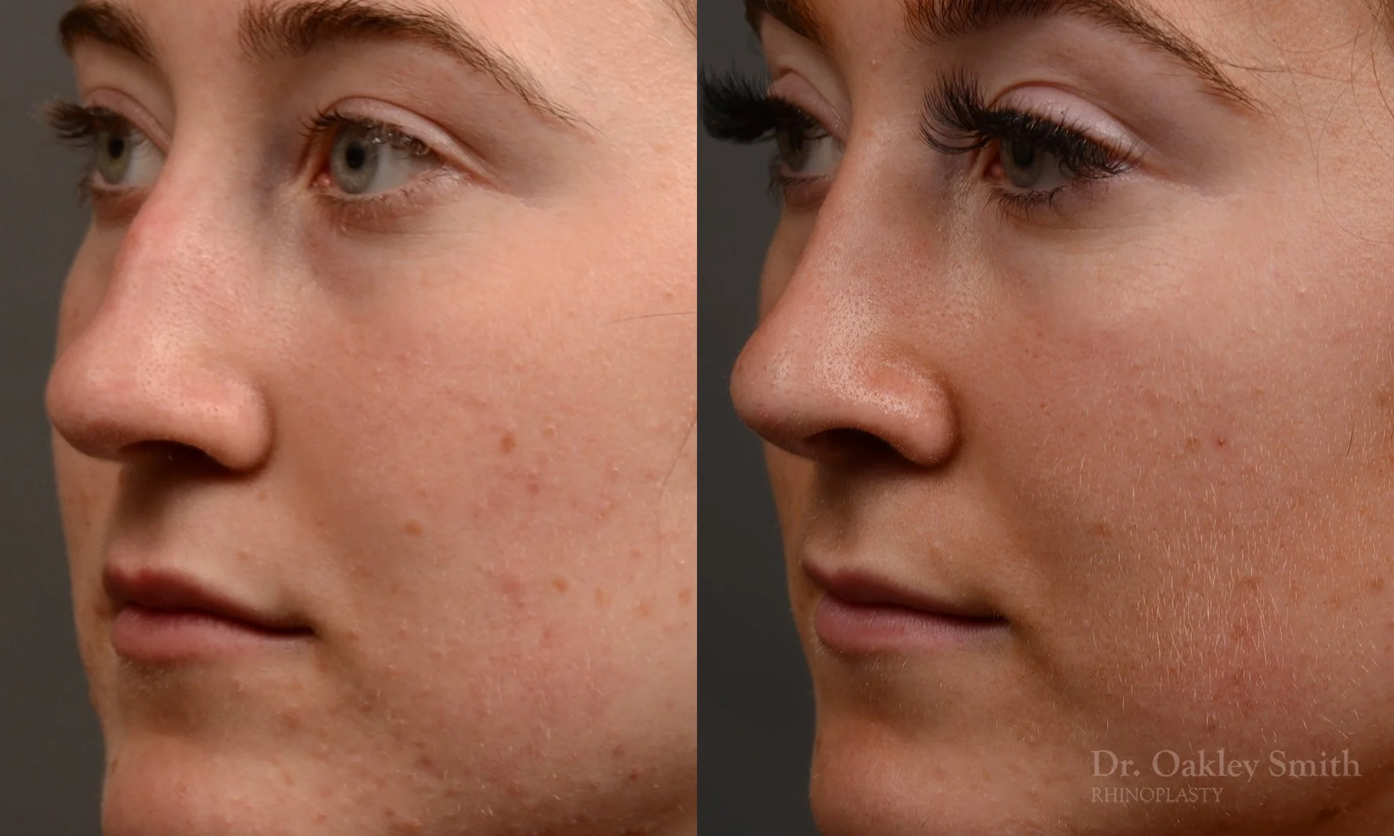 484D-rhinoplasty-dr-oakley-smith-toronto-top-surgeon-nose-job.jpg