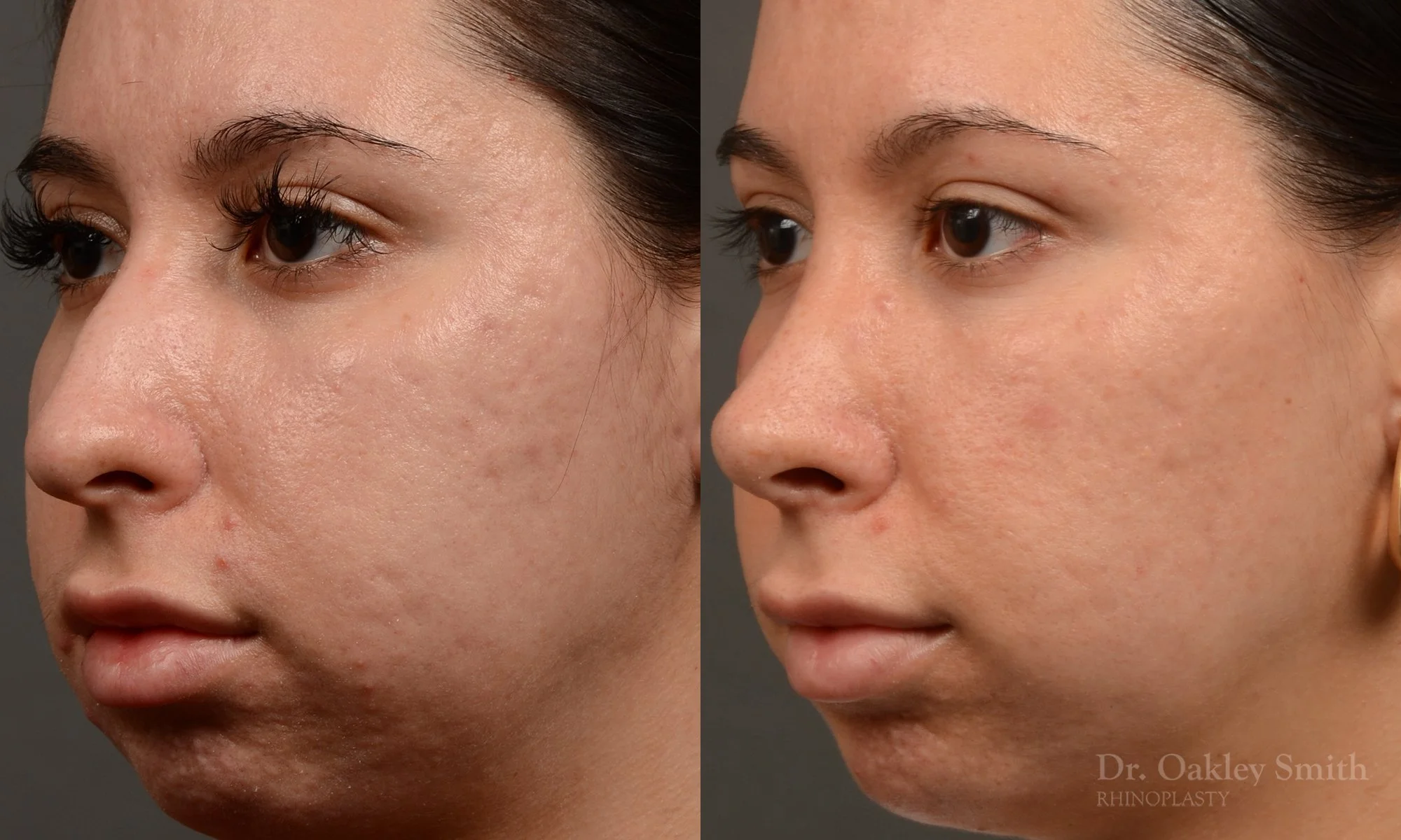 486D-rhinoplasty-dr-oakley-smith-toronto-top-surgeon-nose-job.jpg