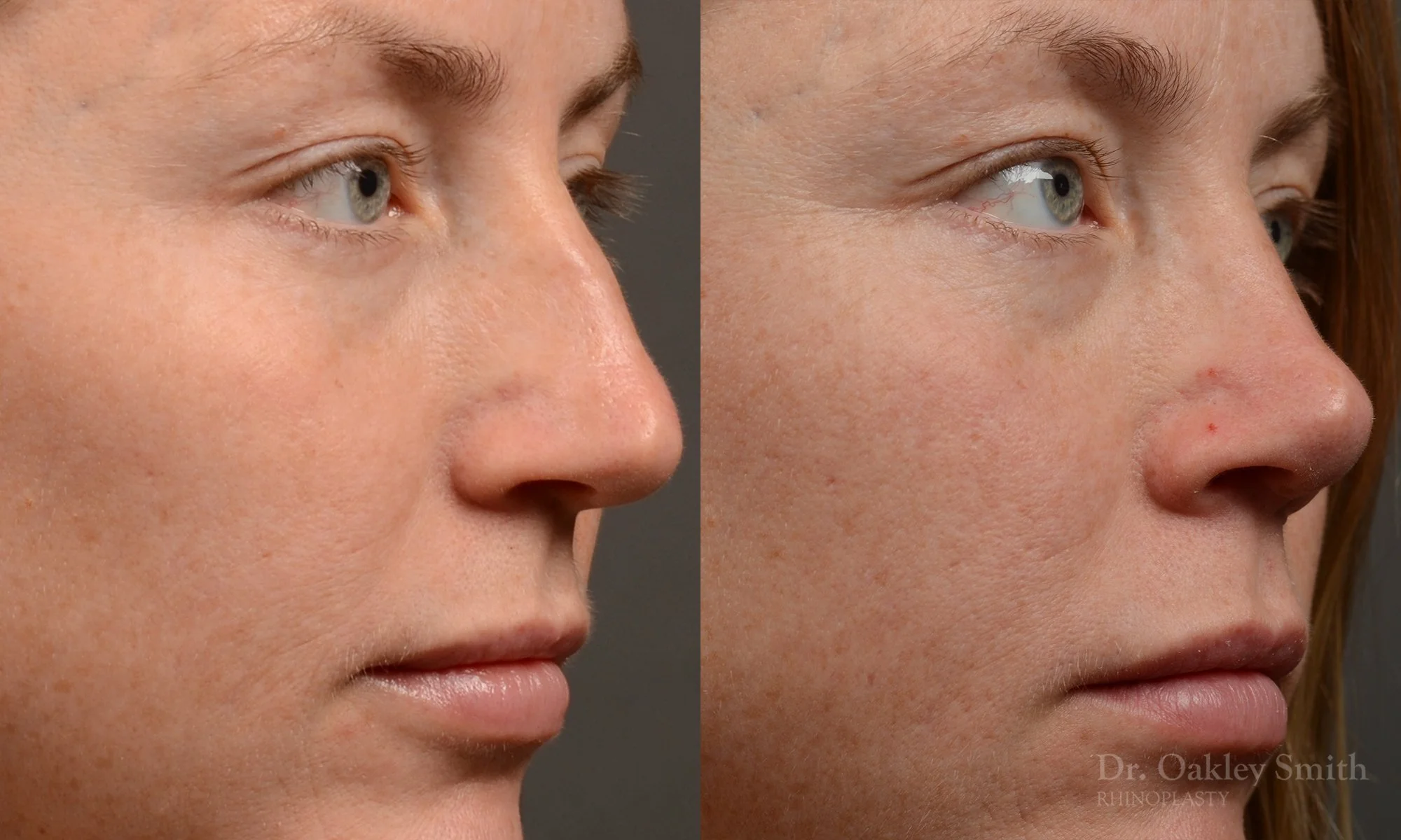 482B-rhinoplasty-dr-oakley-smith-toronto-top-surgeon-nose-job-1.jpg