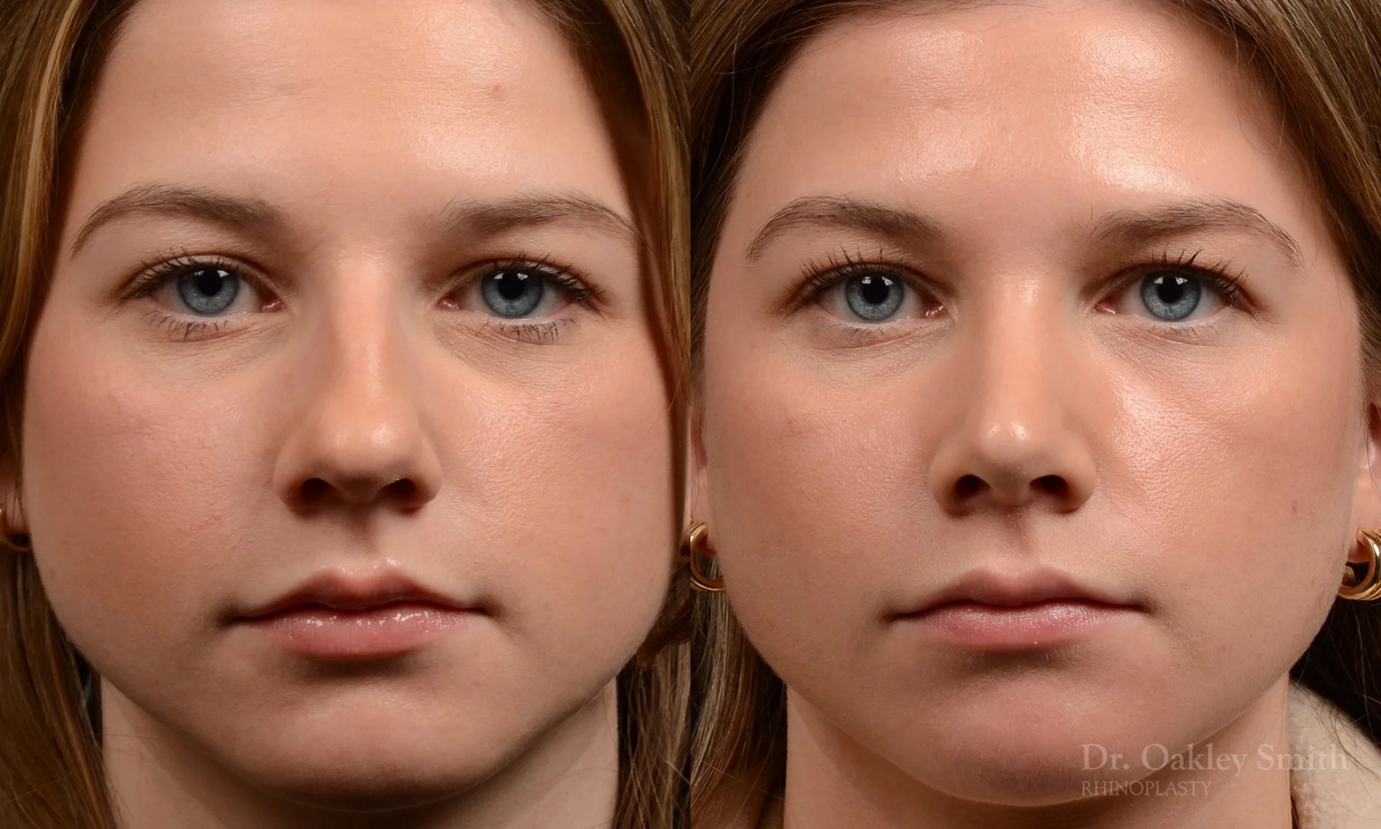 536A-rhinoplasty-dr.-oakley-smith-toronto-nose-job-best.jpg