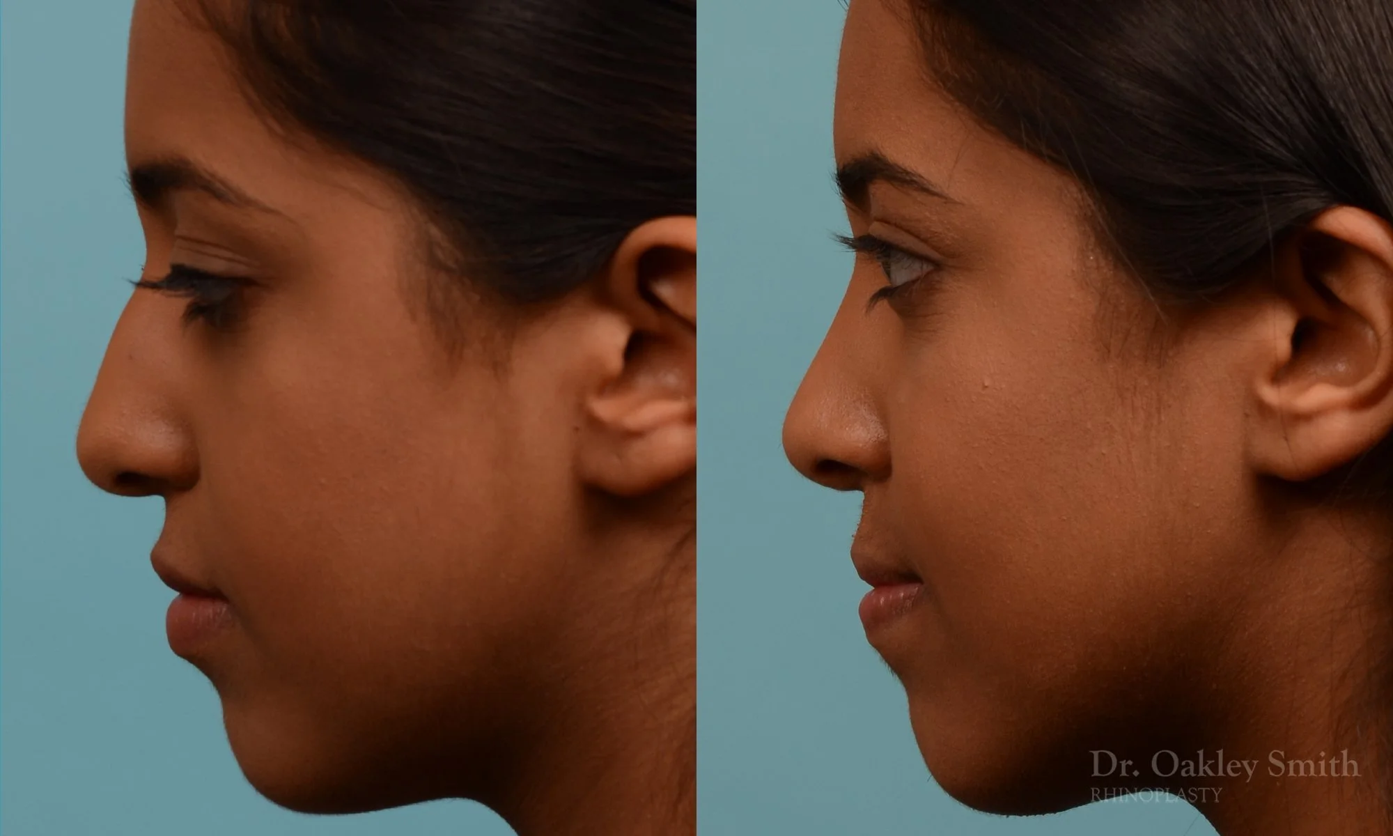 285E-rhinoplasty-dr-oakley-smith-toronto-nose-job.jpg