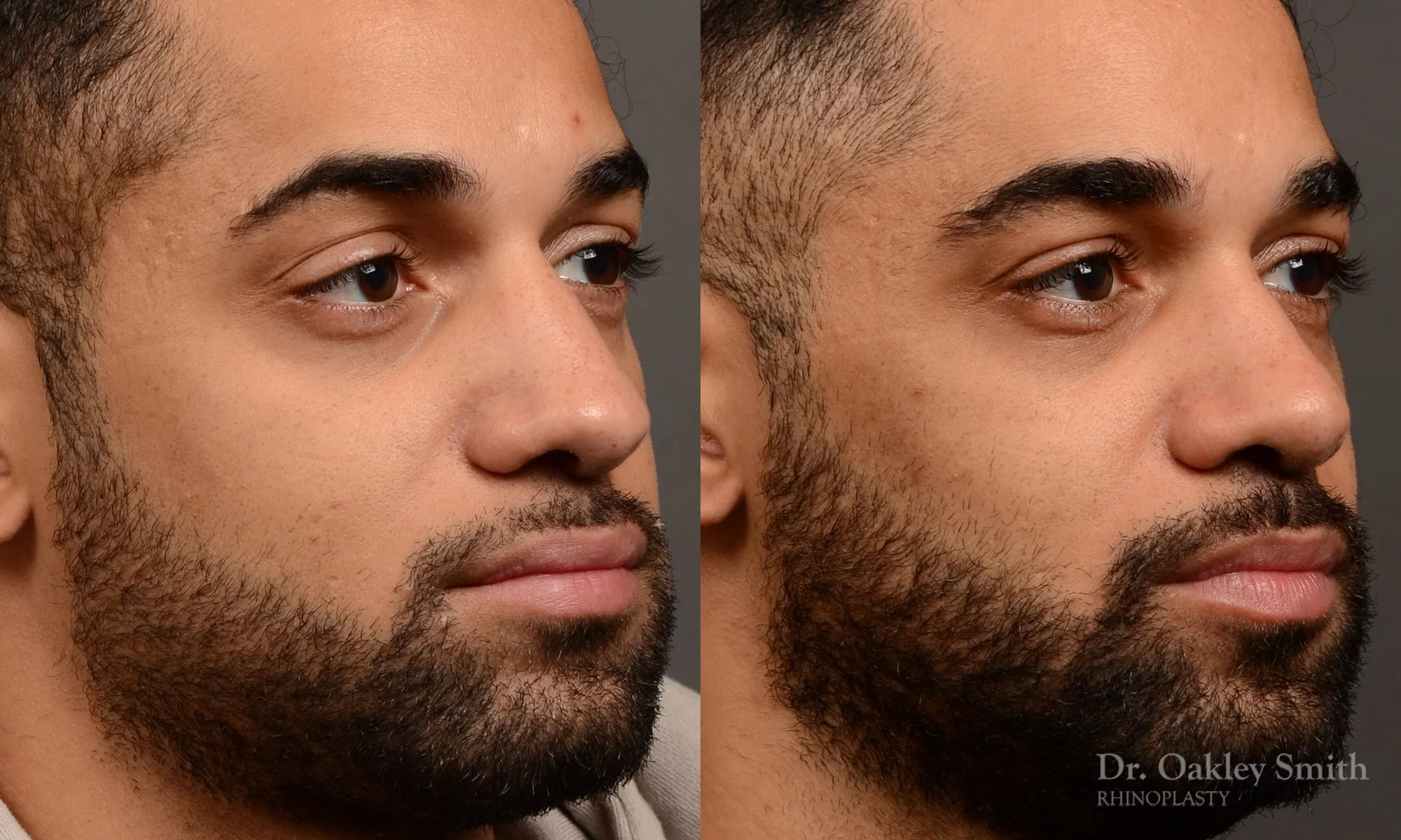 544B-male-rhinoplasty-before-and-after-nose-job-toronto-Dr.-Oakley-Smith.jpg