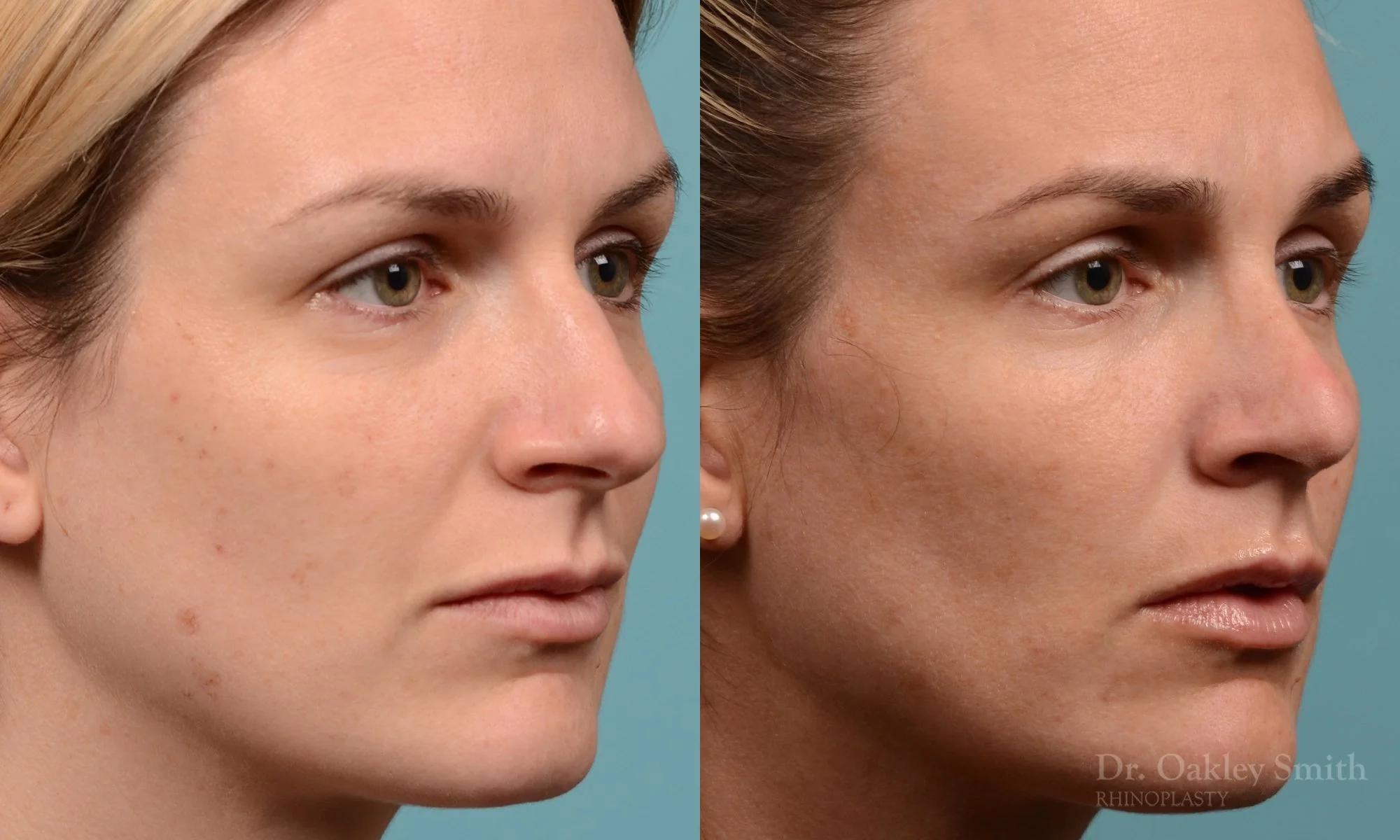 312B-rhinoplasty-dr-oakley-smith-toronto-nose-job.jpg