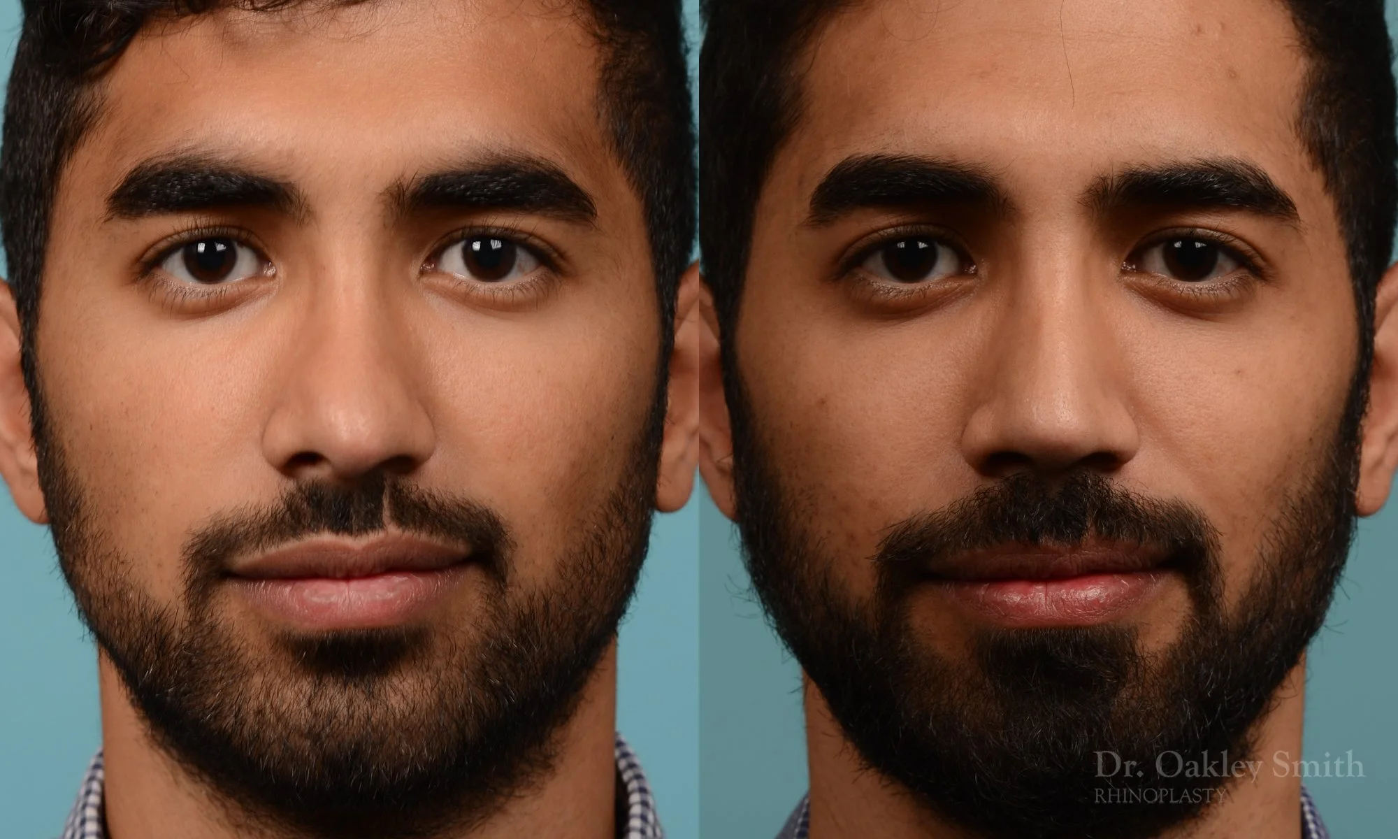 201.1A-rhinoplasty-dr-oakley-smith-toronto-nose-job.jpg