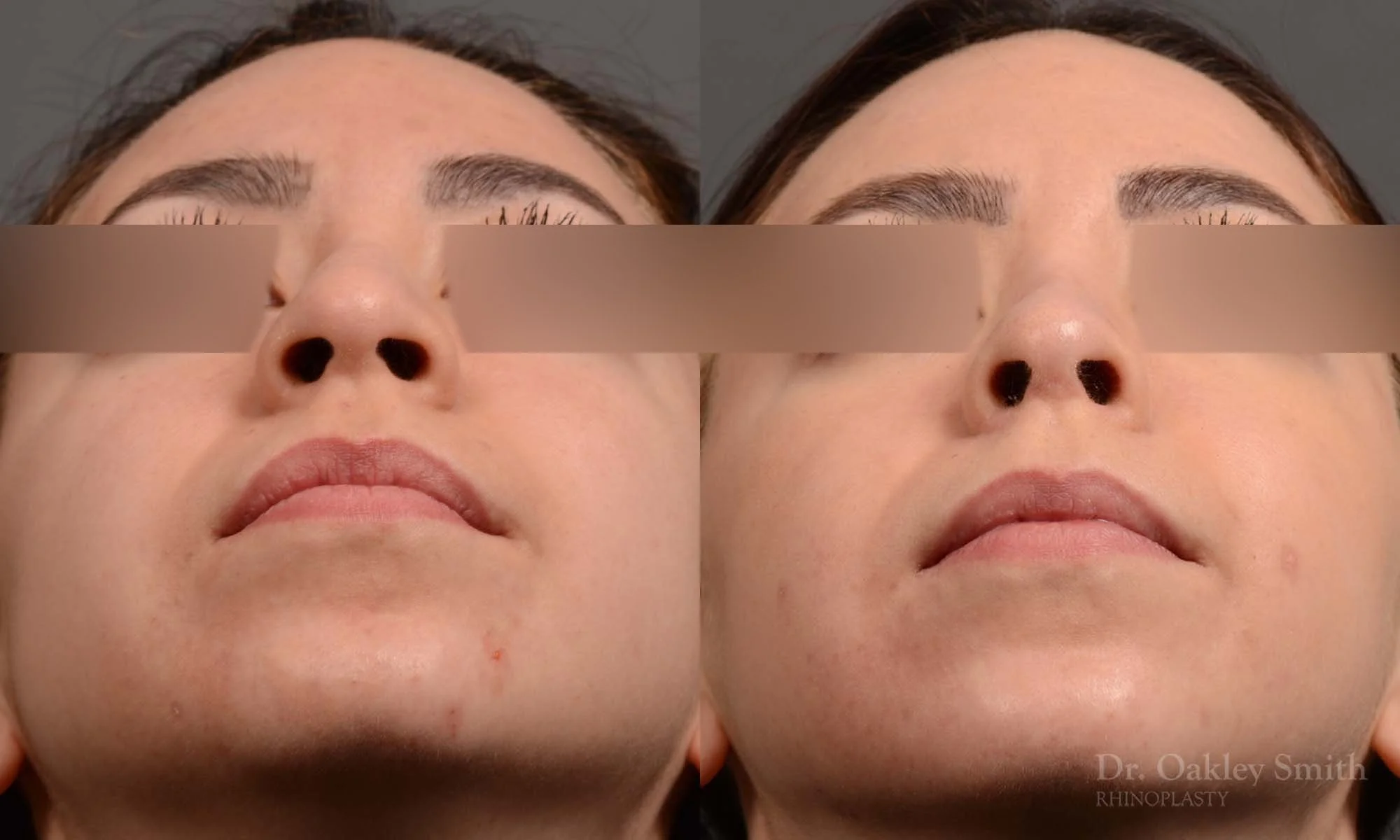 342F-rhinoplasty-dr-oakley-smith-toronto-nose-job.jpg
