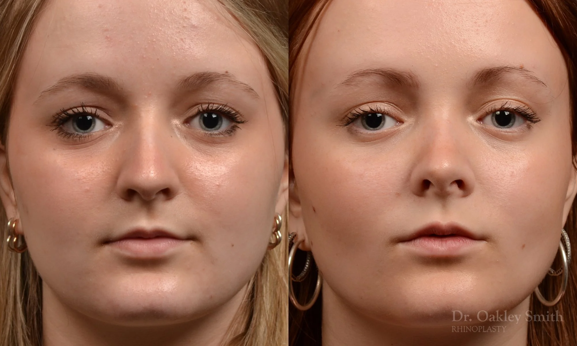 475A-rhinoplasty-dr-oakley-smith-toronto-top-surgeon-nose-job.jpg