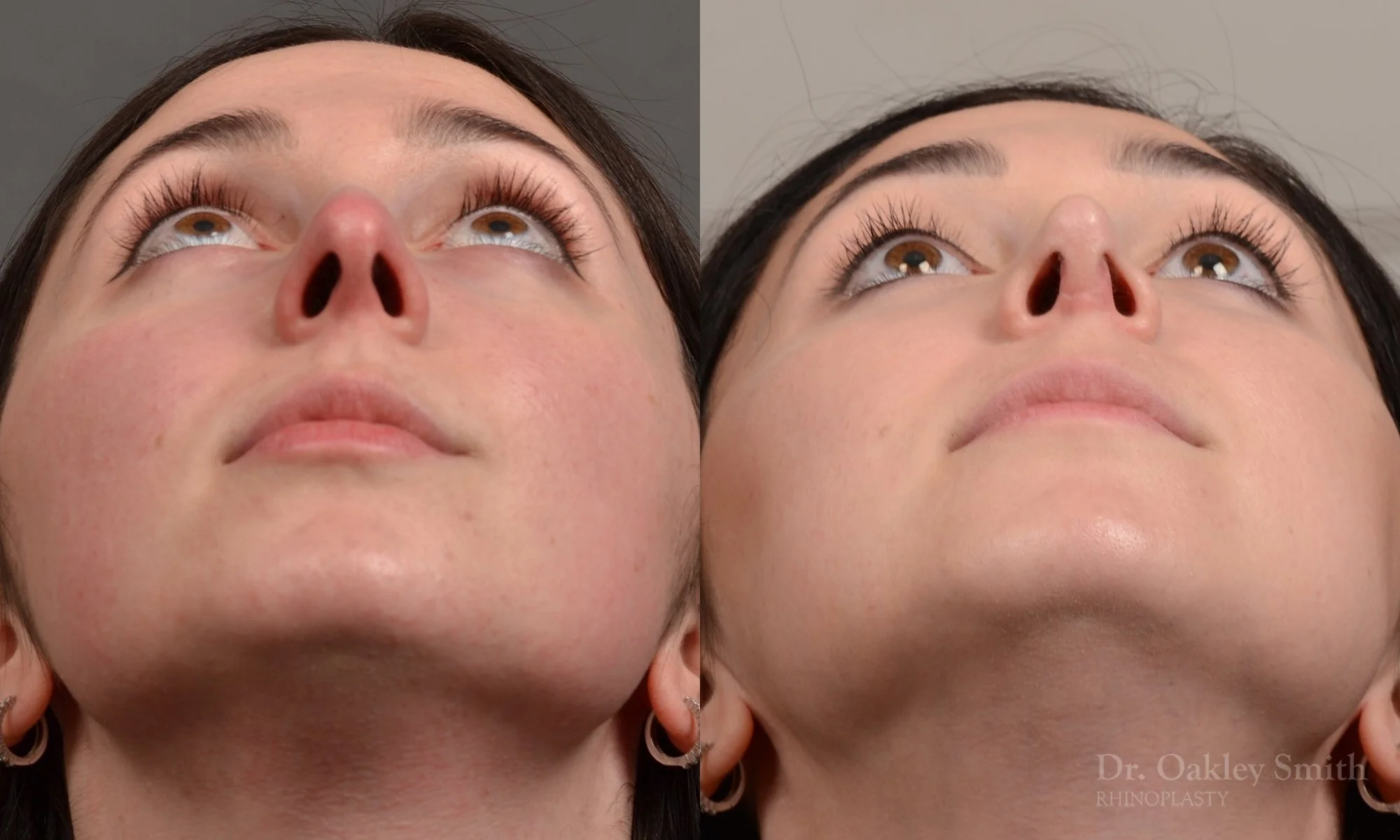 476F-rhinoplasty-dr-oakley-smith-toronto-top-surgeon-nose-job.jpg