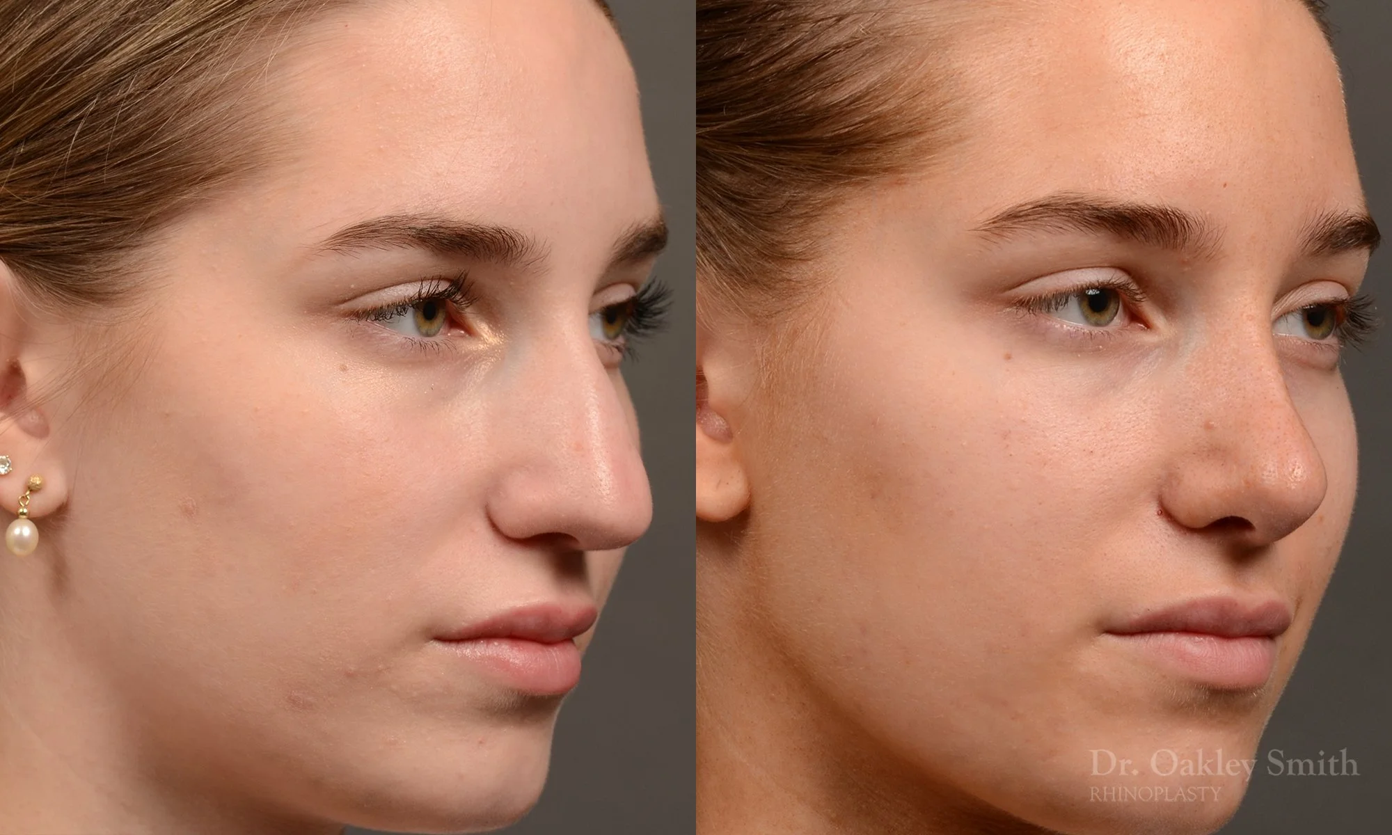 537B-rhinoplasty-before-after-top-toronto-nose-surgeon.jpg