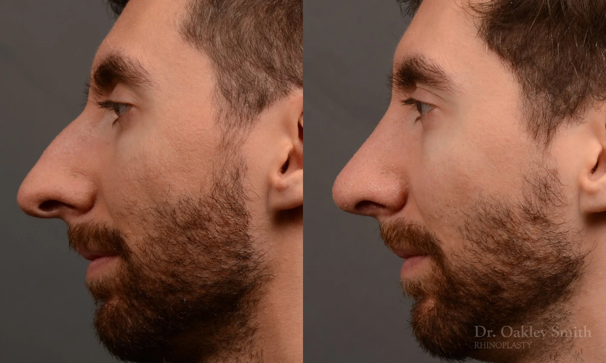 469E-rhinoplasty-dr-oakley-smith-toronto-top-surgeon-nose-job.jpg