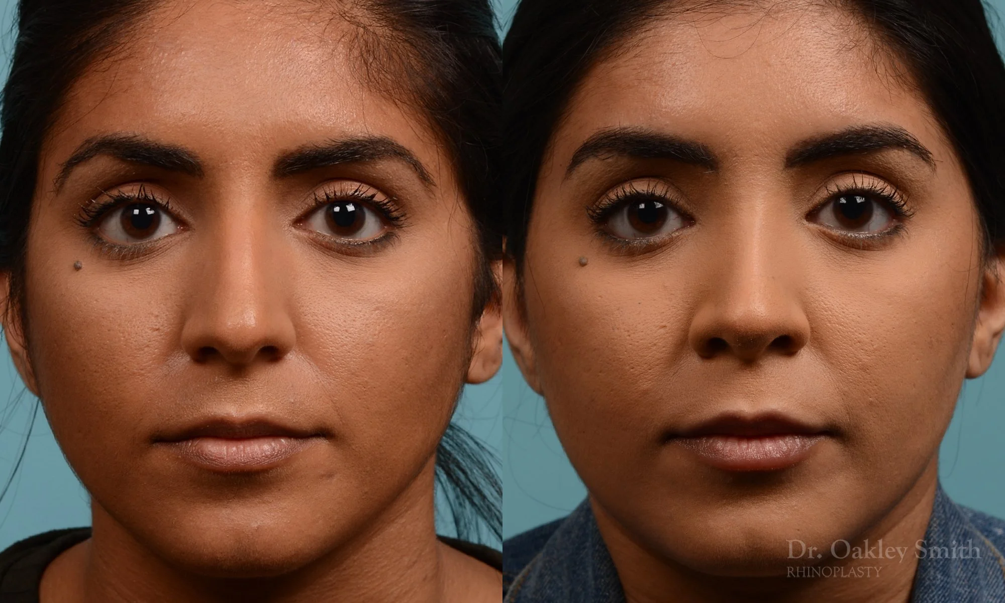 303.1A-rhinoplasty-dr-oakley-smith-toronto-nose-job.jpg