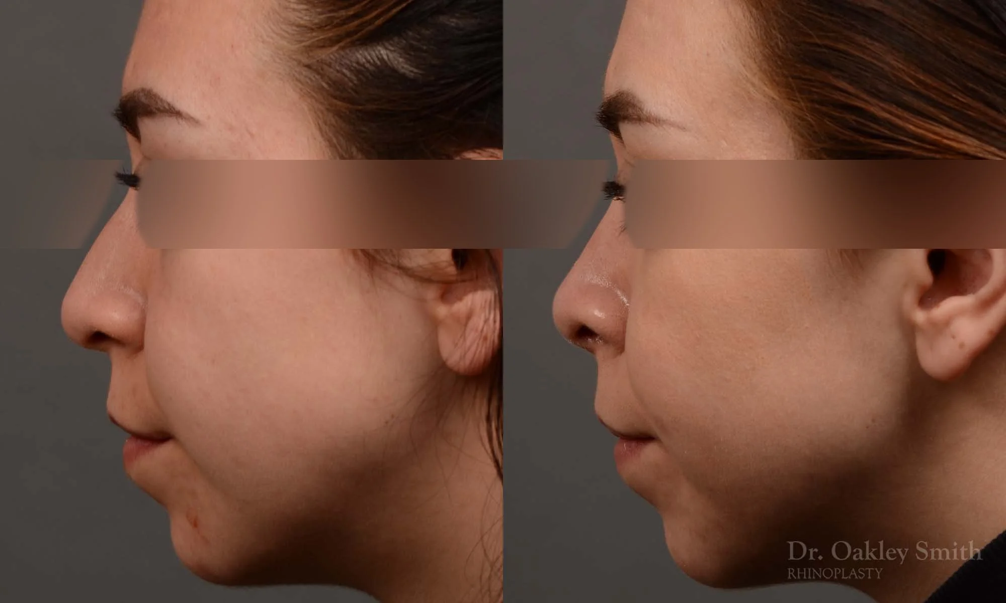 342E-rhinoplasty-dr-oakley-smith-toronto-nose-job.jpg