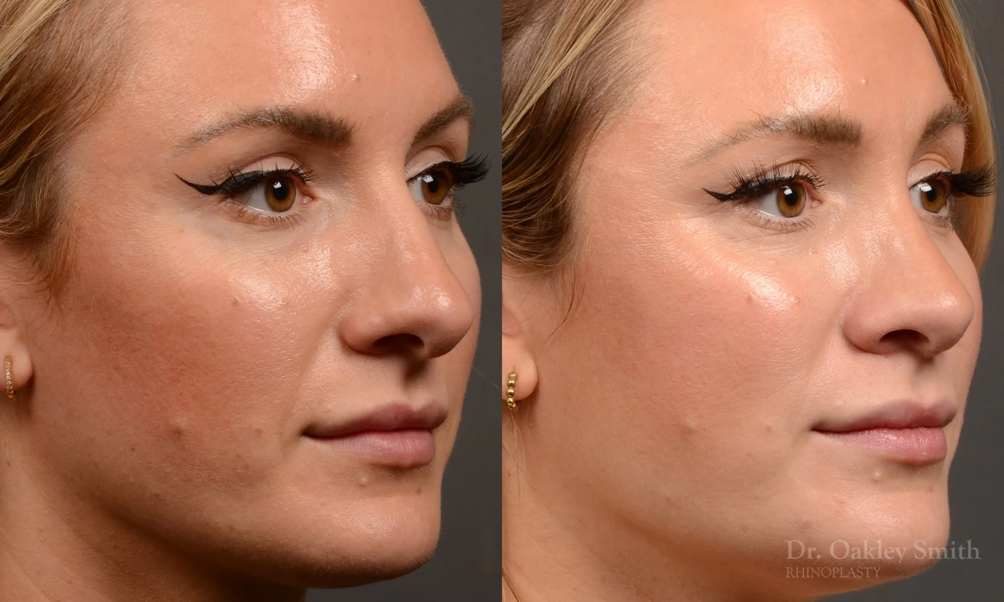 550B-rhinoplasty-nose-job-toronto-nose-surgeon-dr-oakley-smith.jpg