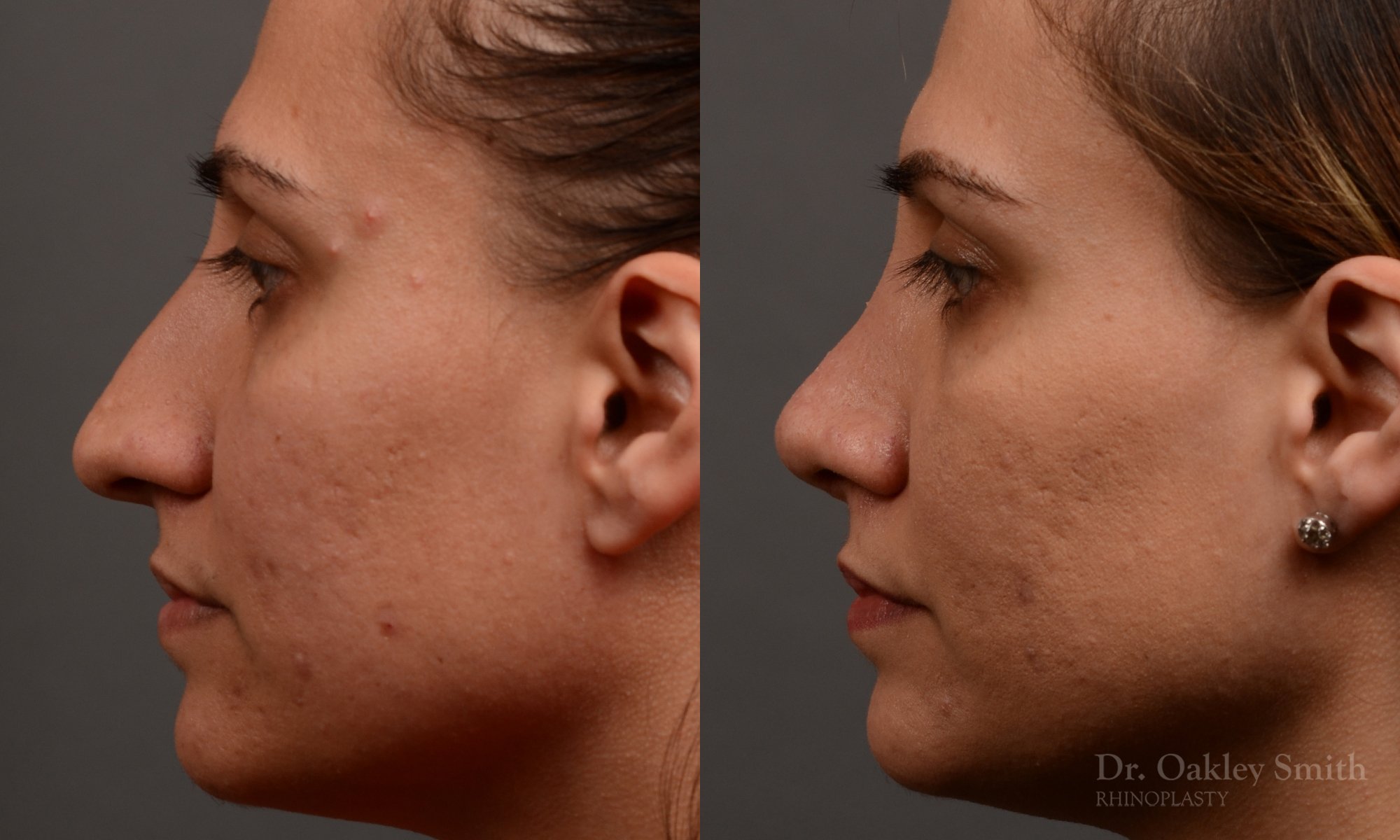 351E-rhinoplasty-dr-oakley-smith-toronto-nose-job.jpg