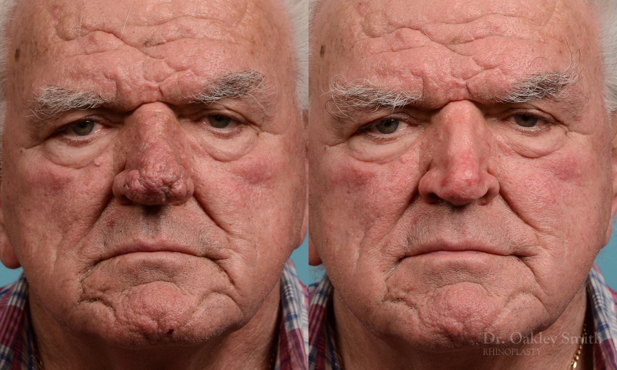 Case 245, Dr. Oakley Smith, rhinophyma, 12 months after surgery, frontal view