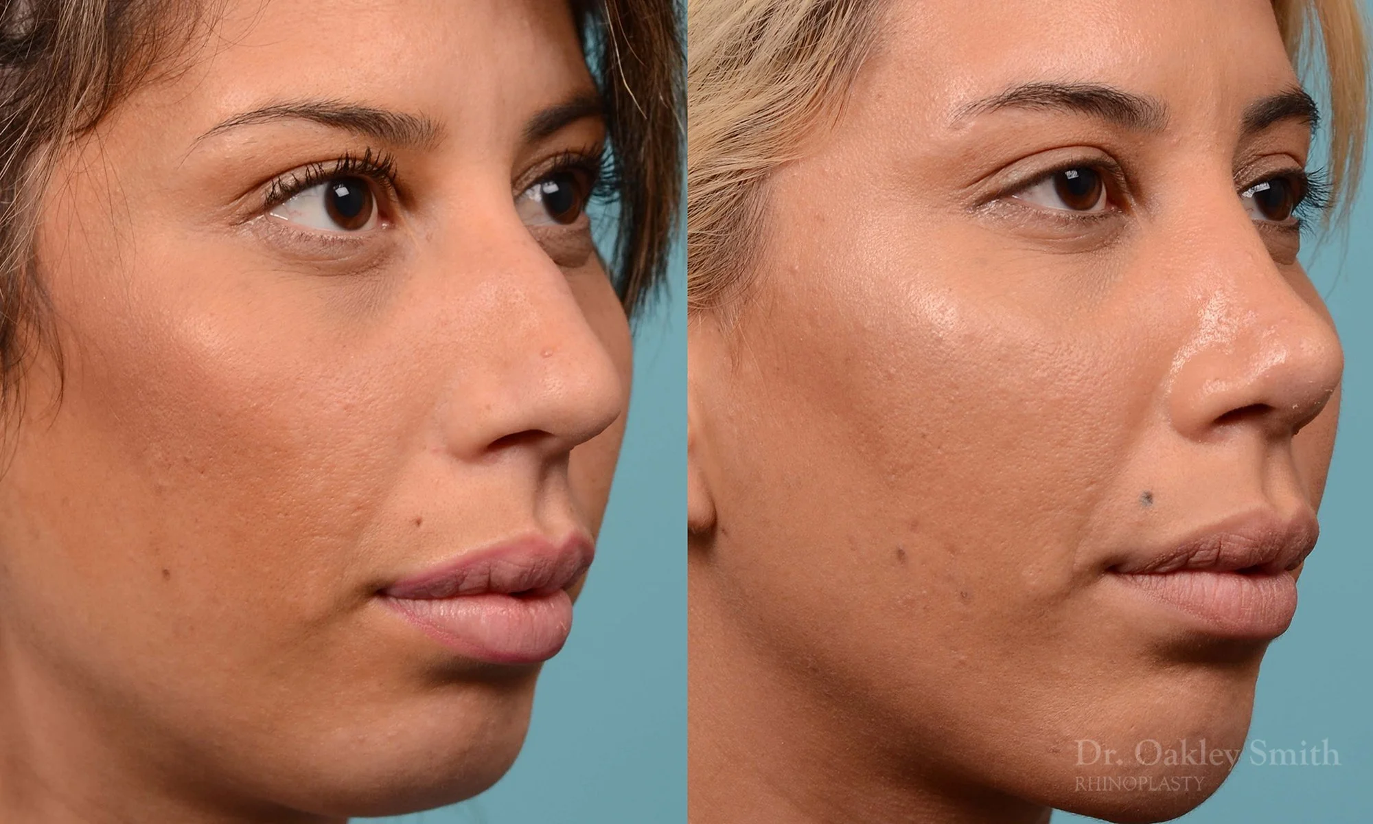 200B-nose-job-rhinoplasty-toronto-dr.-oakley-smith-septum-2.jpg