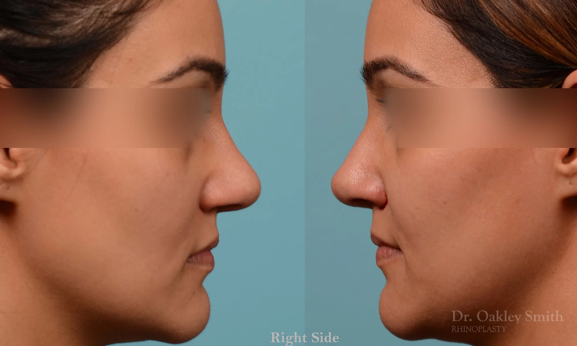 223: Female, Ethnic Rhinoplasty, Thick Skin, Dorsal Hump, Tip Refinement