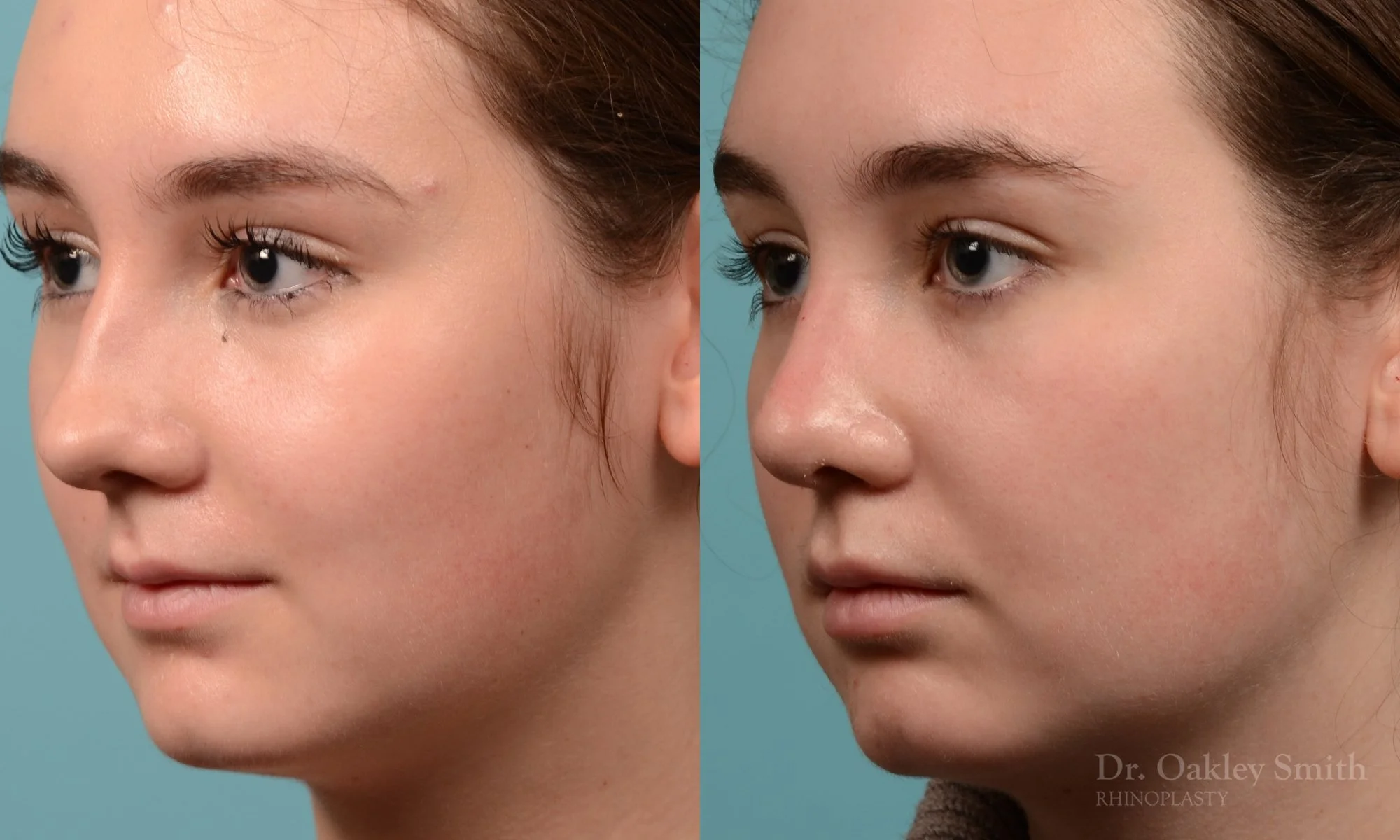 264D-rhinoplasty-dr-oakley-smith-toronto-nose-job.jpg