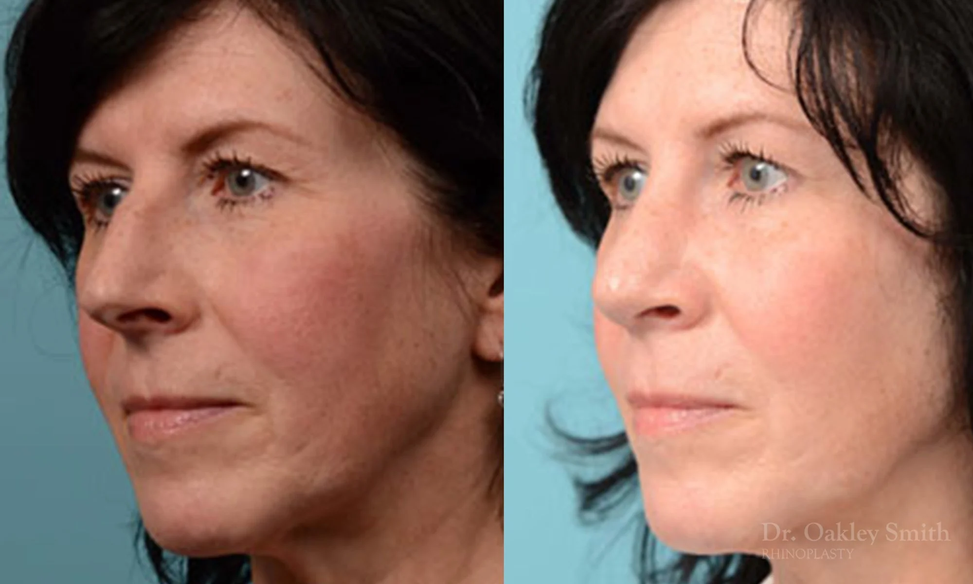 324E-rhinoplasty-dr-oakley-smith-toronto-nose-job.jpg