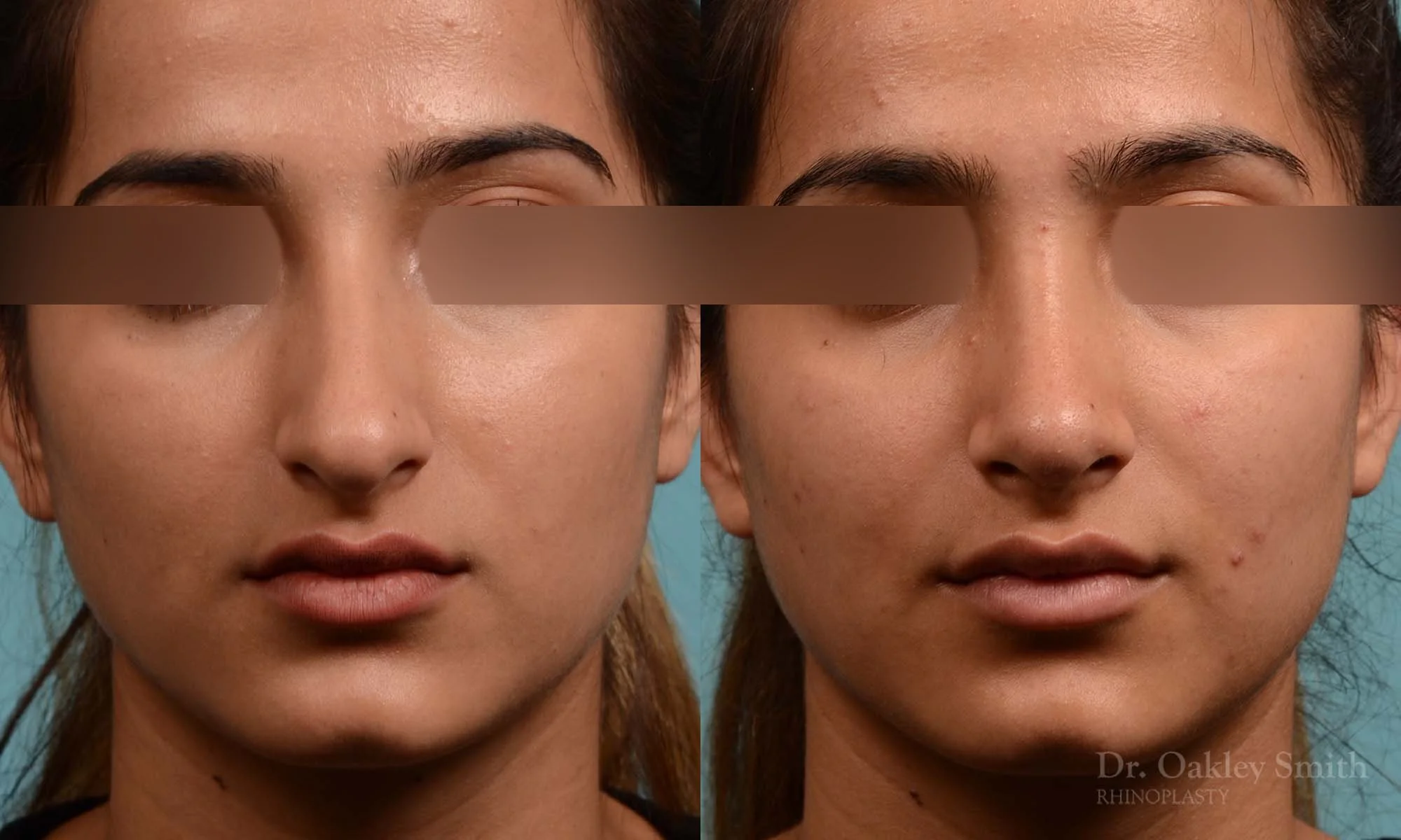 308A-rhinoplasty-dr-oakley-smithm-toronto-nose-job.jpg