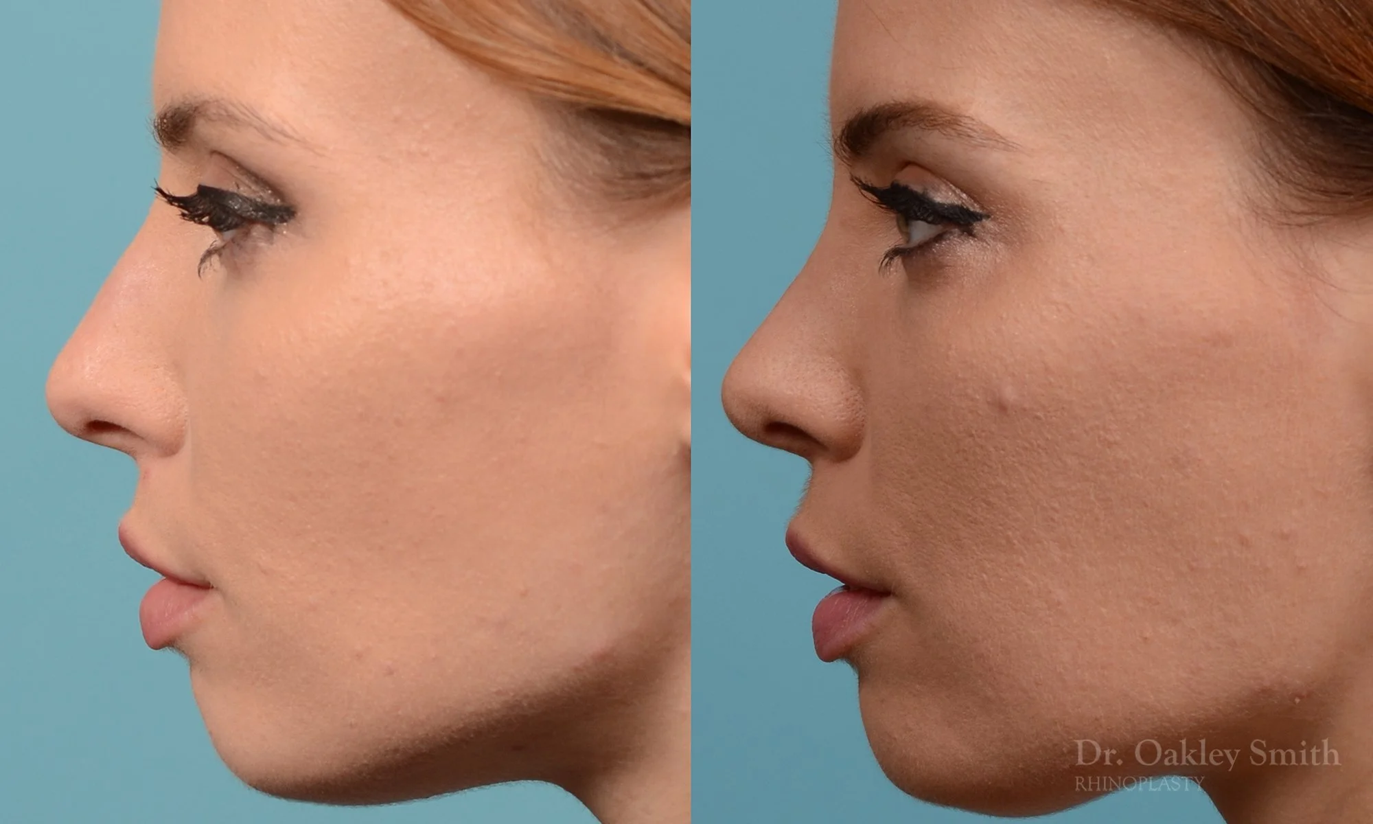 231E-rhinoplasty-dr-oakley-smith-toronto-nose-job-long-nose-bump-bridge-2.jpg