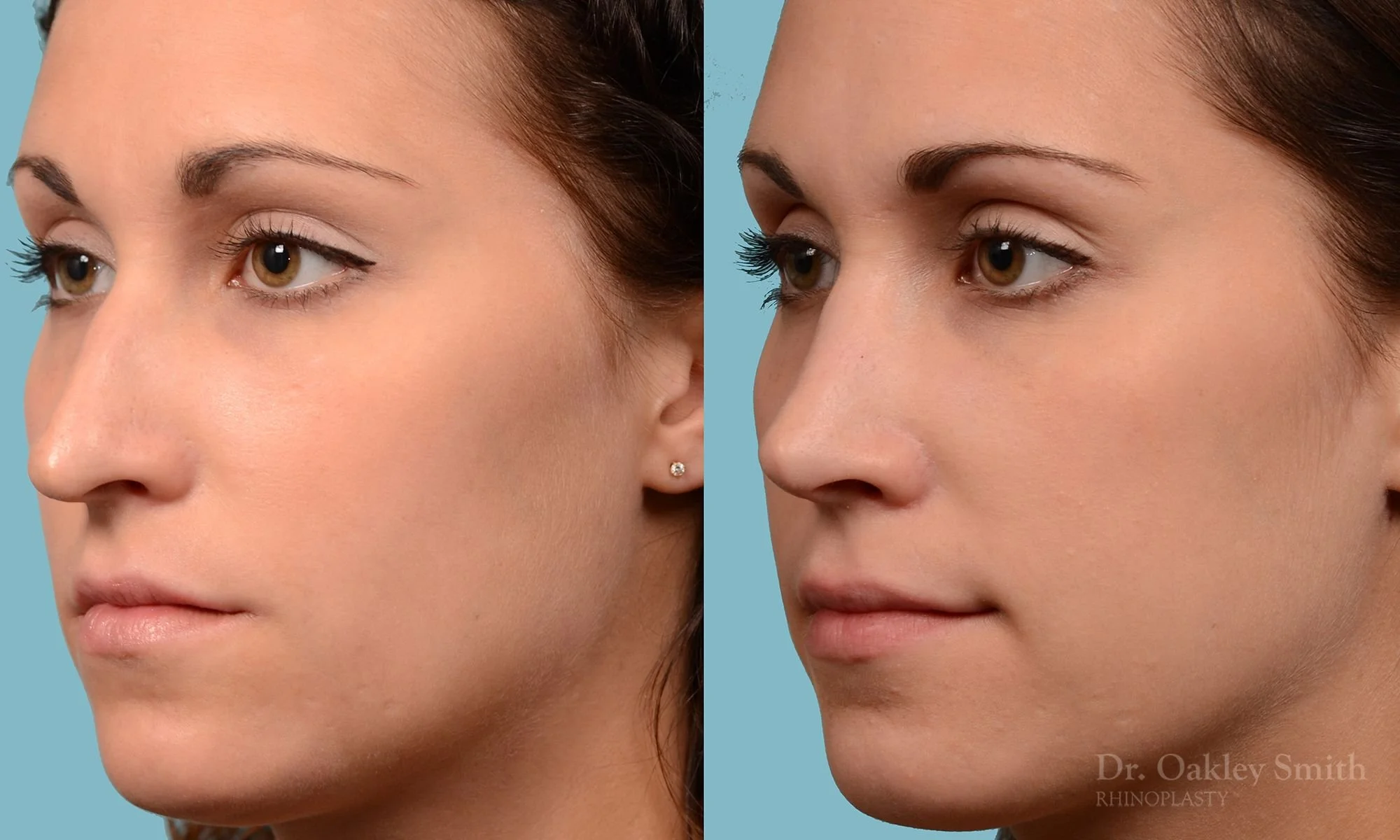 224D-rhinoplasty-nose-job-dr-oakley-smith-toronto-long-nose-large-nose-straight-nose-bridge-1.jpg