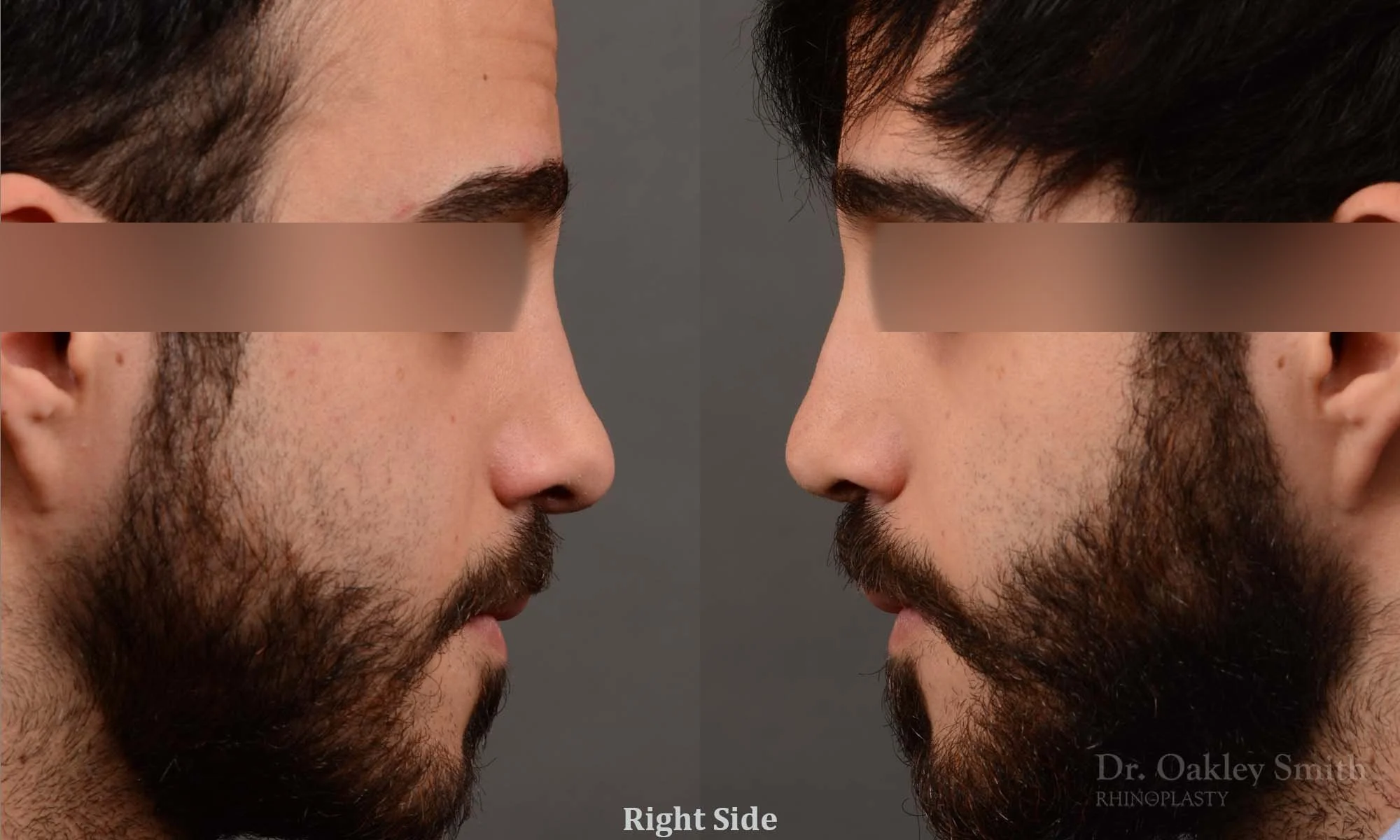 327.1C-rhinoplasty-dr-oakley-smith-toronto-nose-job.jpg
