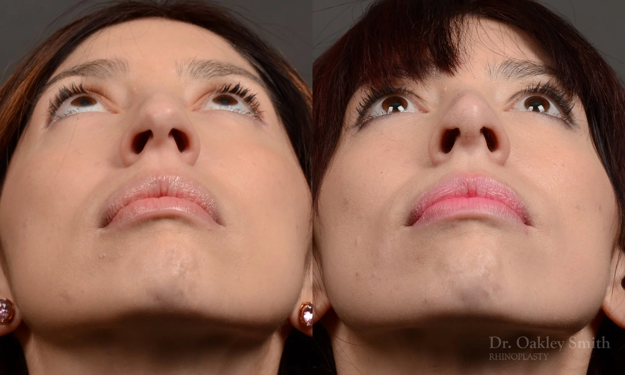 52FA-rhinoplasty-dr-oakley-smith-toronto-top-surgeon-nose-job.jpg