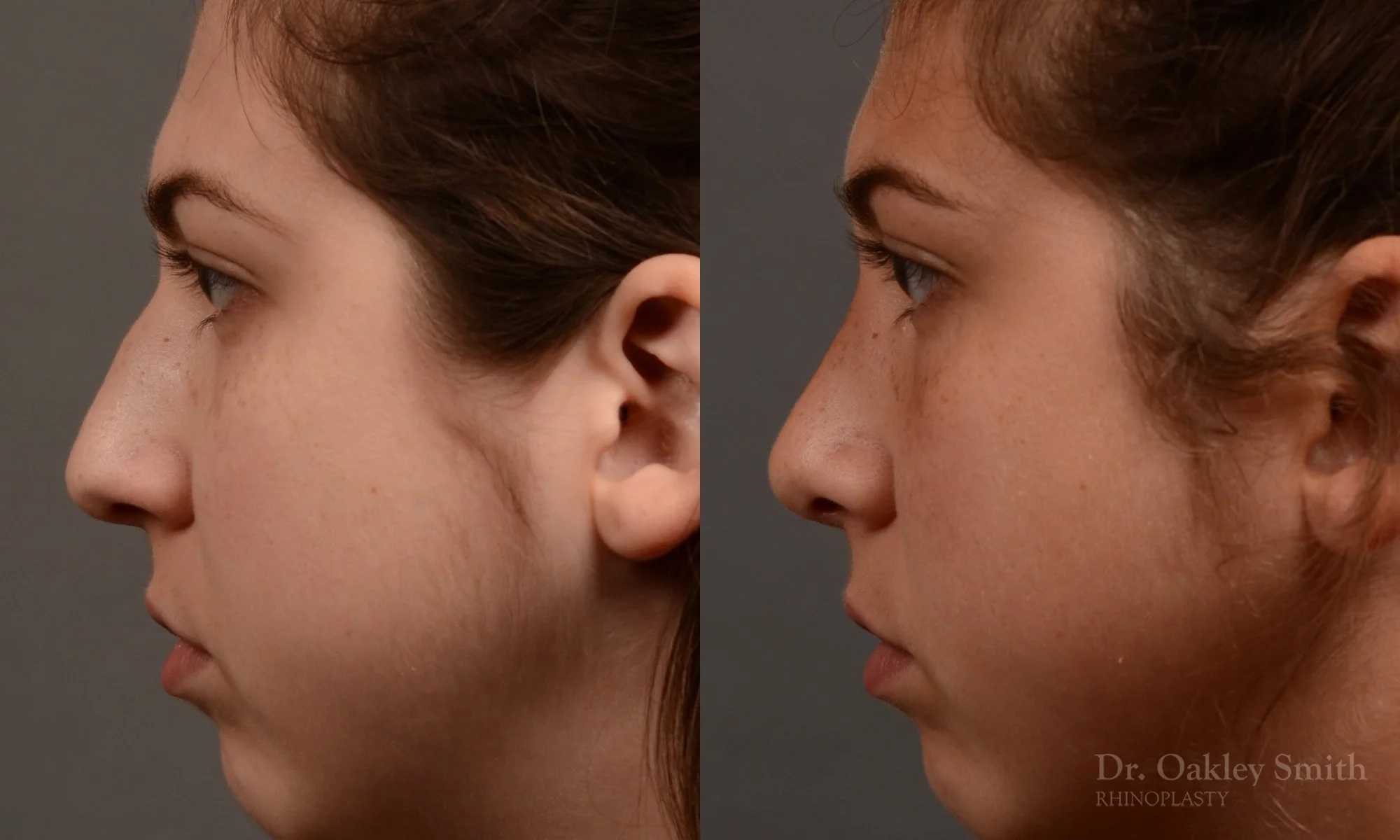371E-rhinoplasty-dr-oakley-smith-toronto-nose-job.jpg