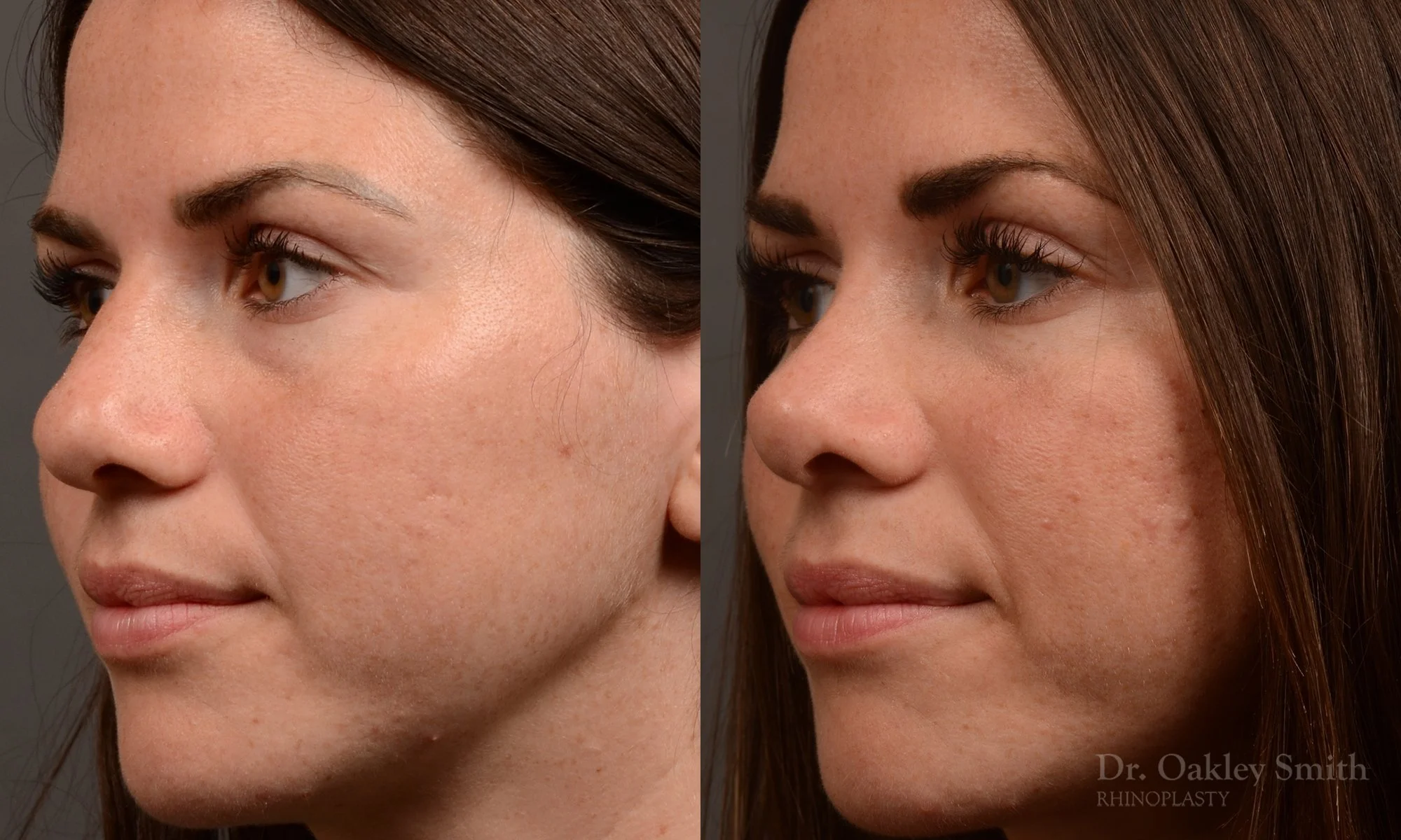 481D-rhinoplasty-dr-oakley-smith-toronto-top-surgeon-nose-job.jpg