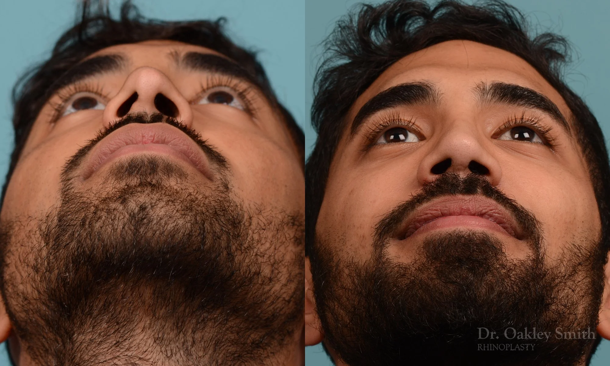 201.1F-rhinoplasty-dr-oakley-smith-toronto-nose-job.jpg