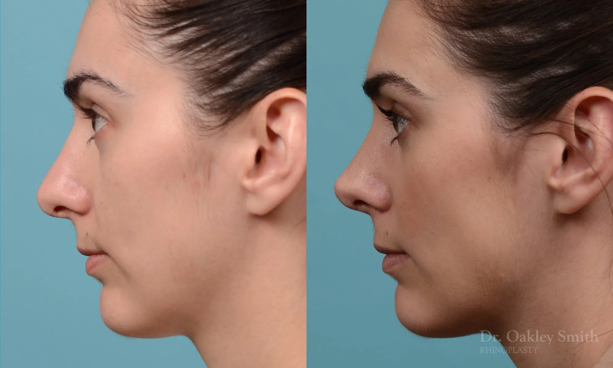 288E-rhinoplasty-dr-oakley-smith-toronto-nose-job (1).jpg