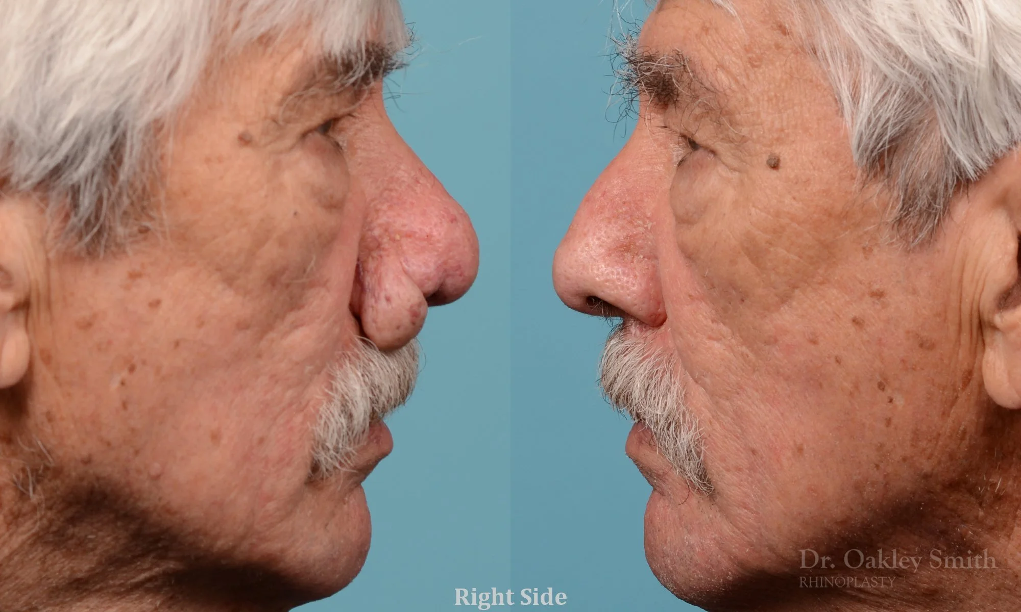 227C-rhinophyma-rhinoplasty-dr-oakley-smith-toronto-nose-job-1.jpg