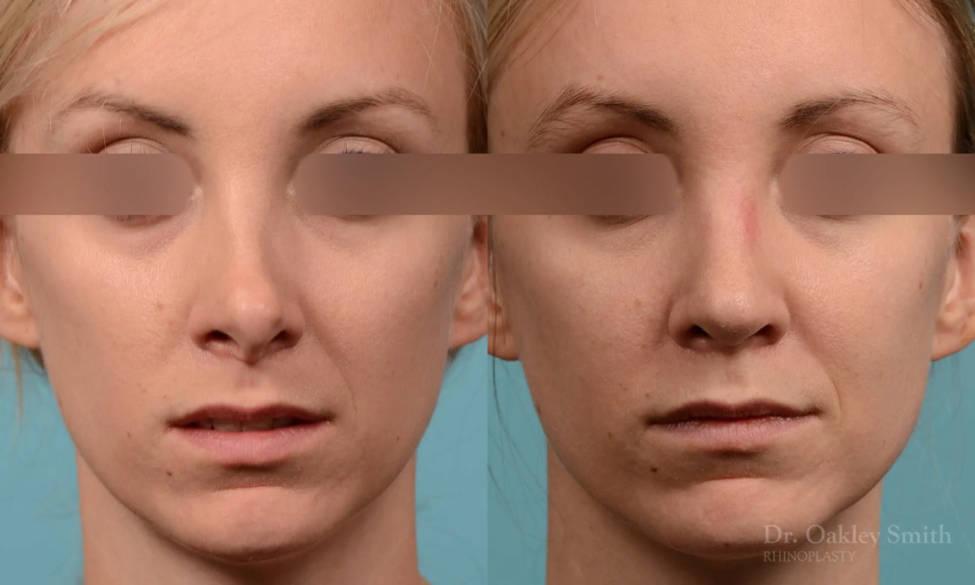 280A-rhinoplasty-dr-oakley-smith-toronto-nose-job.jpg