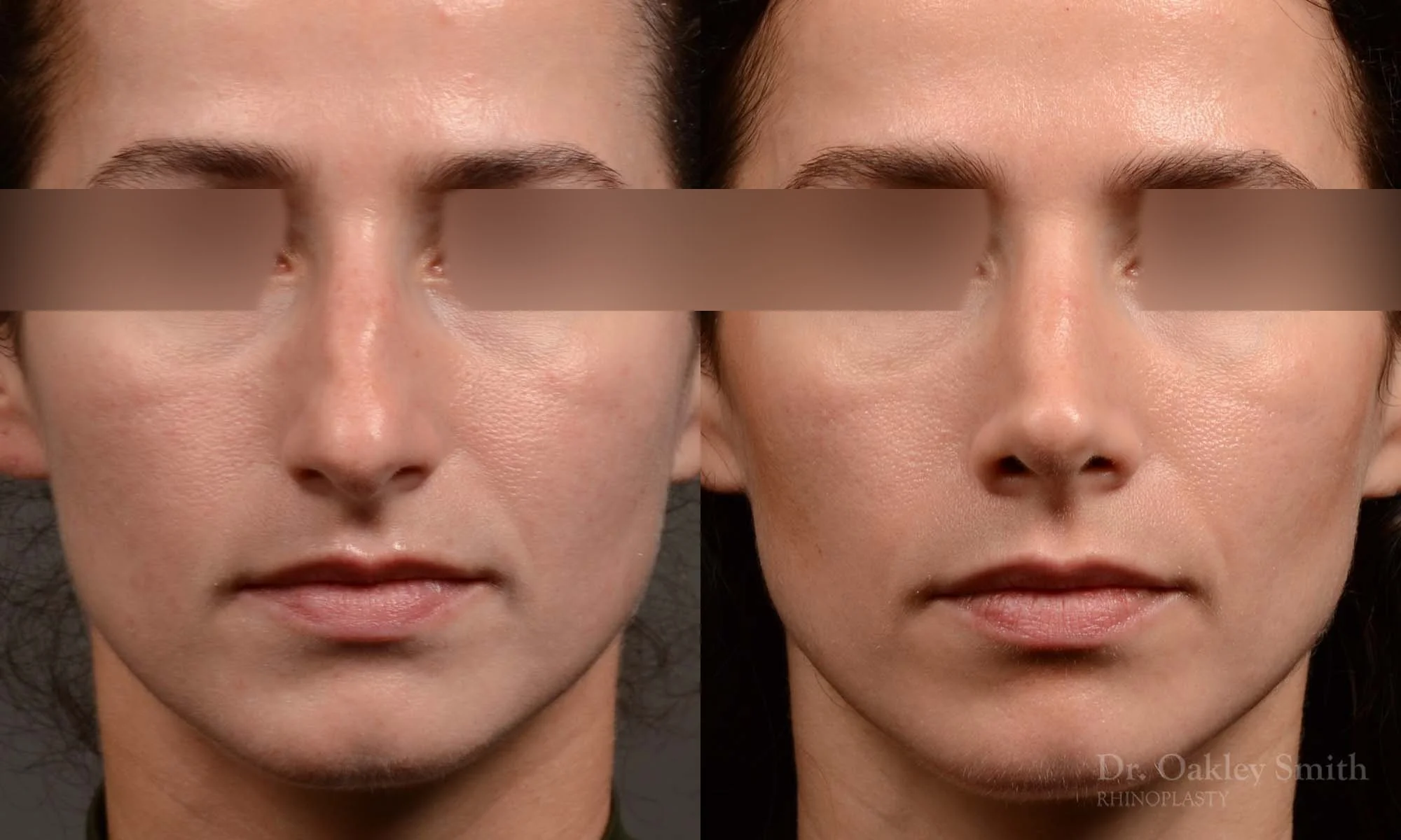529A-rhinoplasty-dr-oakley-smith-toronto-top-surgeon-nose-job.jpg
