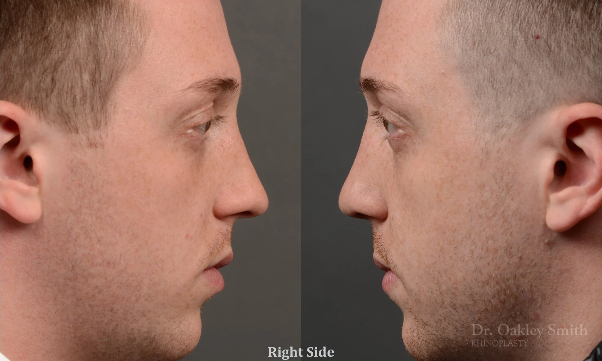 339.1C-rhinoplasty-dr-oakley-smith-toronto-male-nose-job.jpg