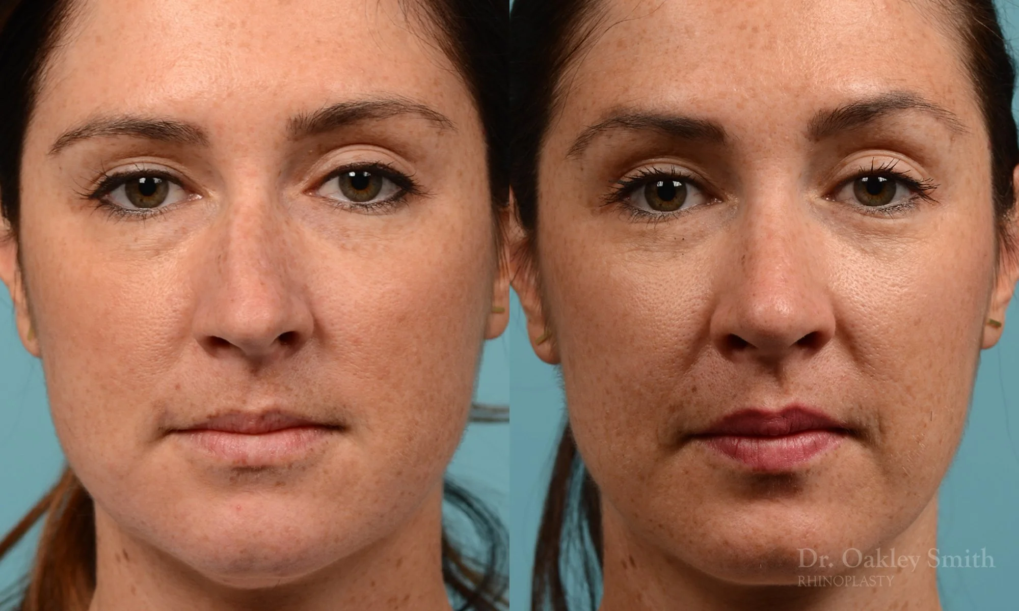 302A-rhinoplasty-dr-oakley-smith-toronto-nose-job.jpg