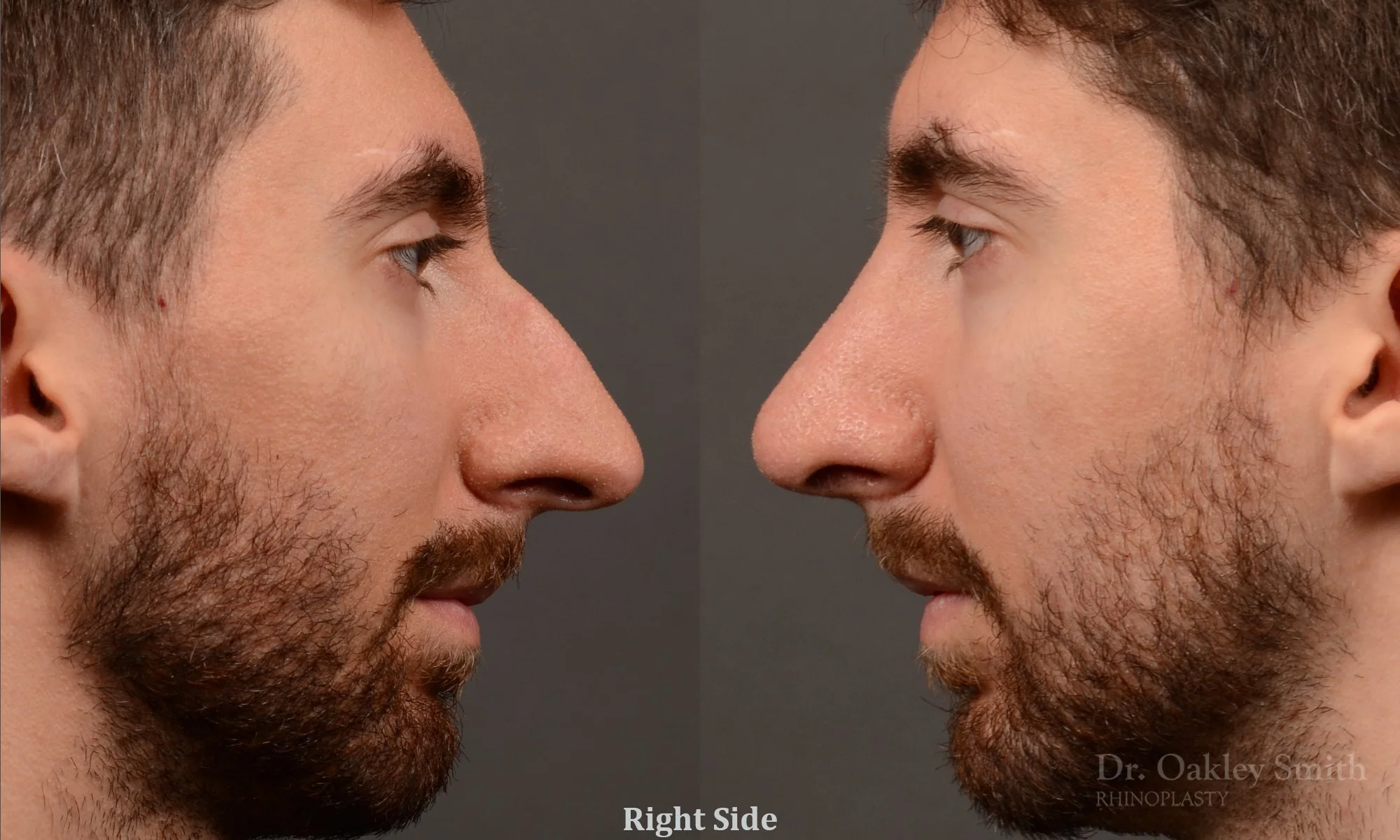 469C-rhinoplasty-dr-oakley-smith-toronto-top-surgeon-nose-job.jpg