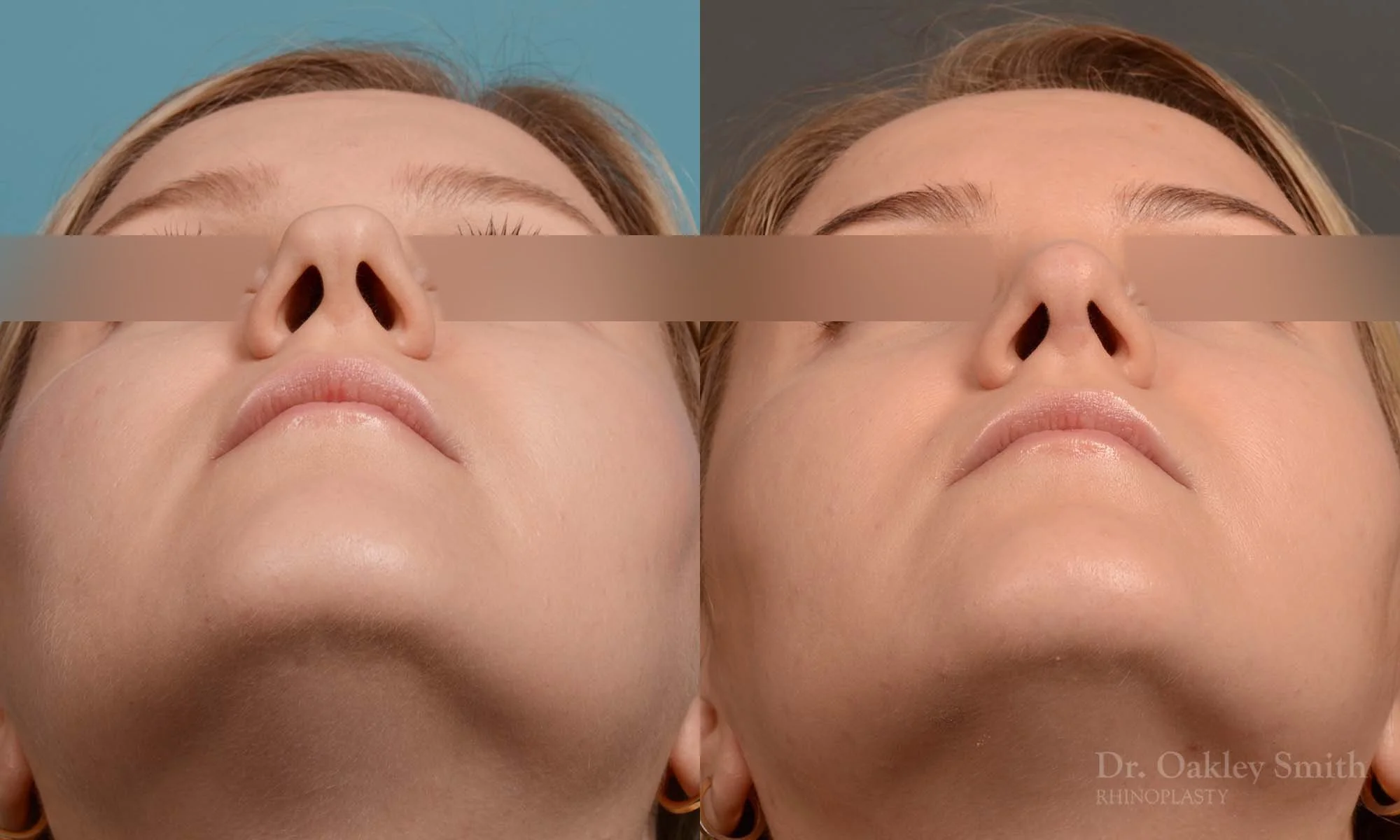 292F-rhinoplasty-dr-oakley-smith-toronto-nose-job.jpg