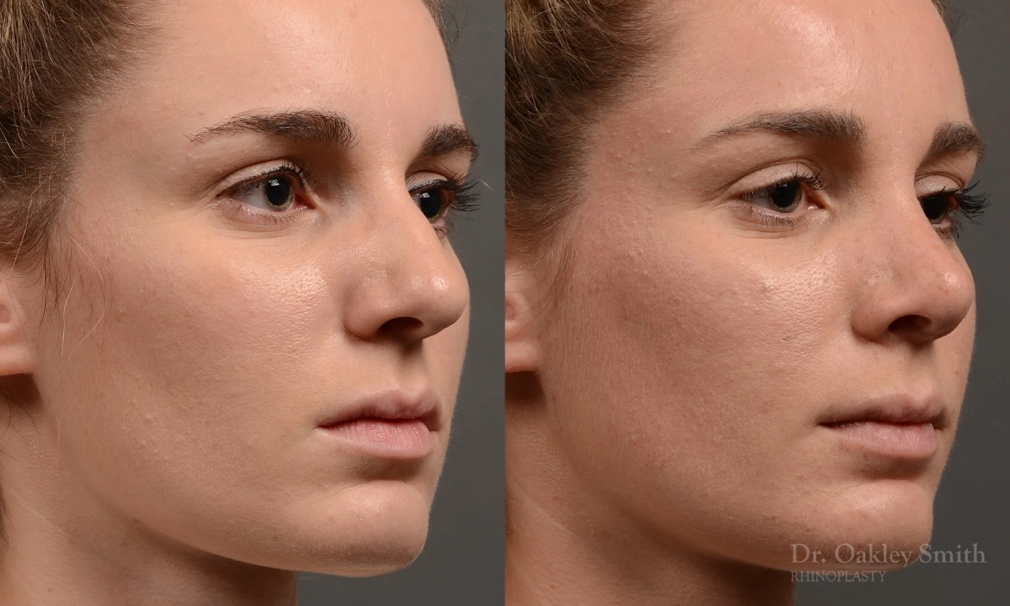 358B-rhinoplasty-dr-oakley-smith-toronto-nose-job.jpg