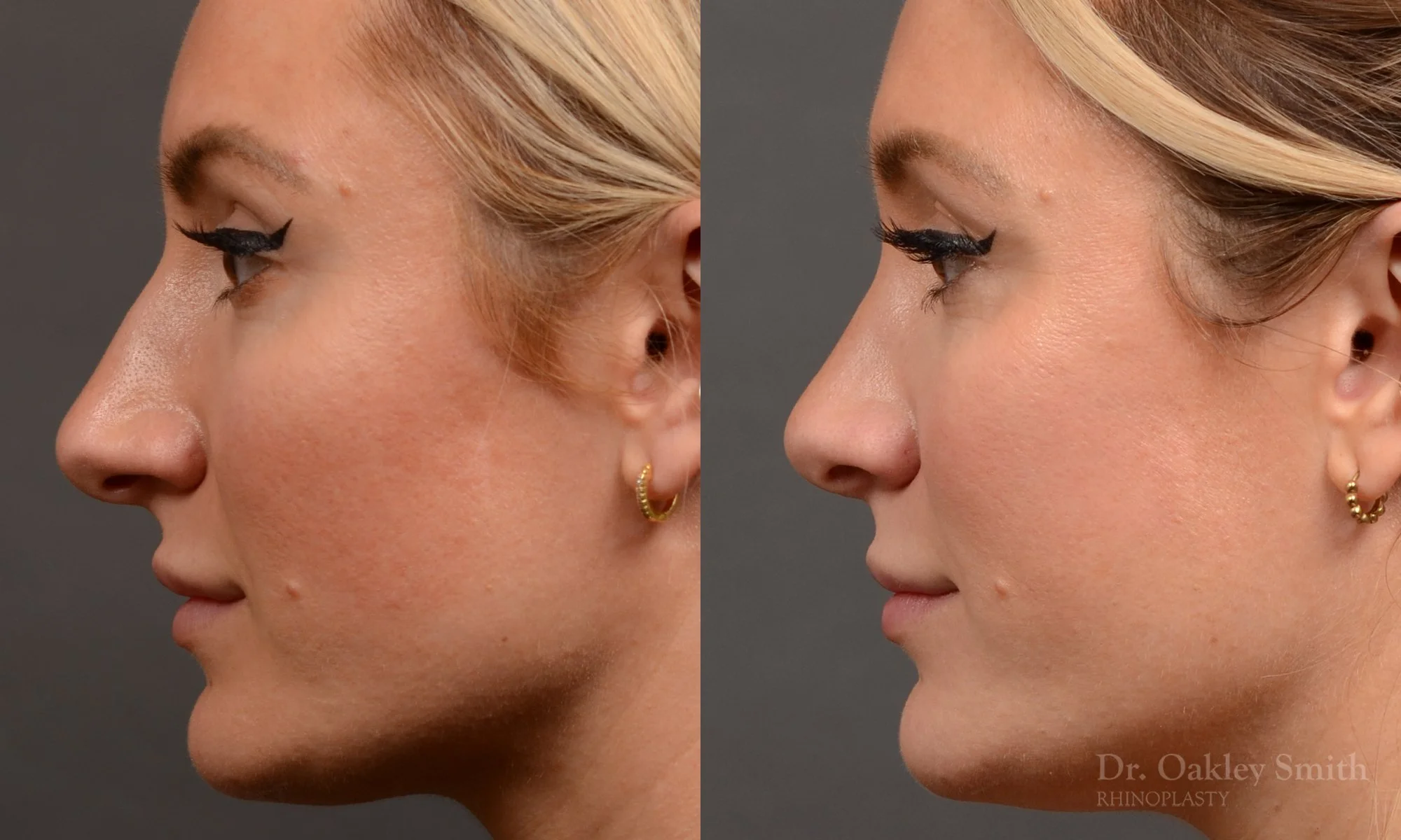 550E-rhinoplasty-nose-job-toronto-nose-surgeon-dr-oakley-smith.jpg