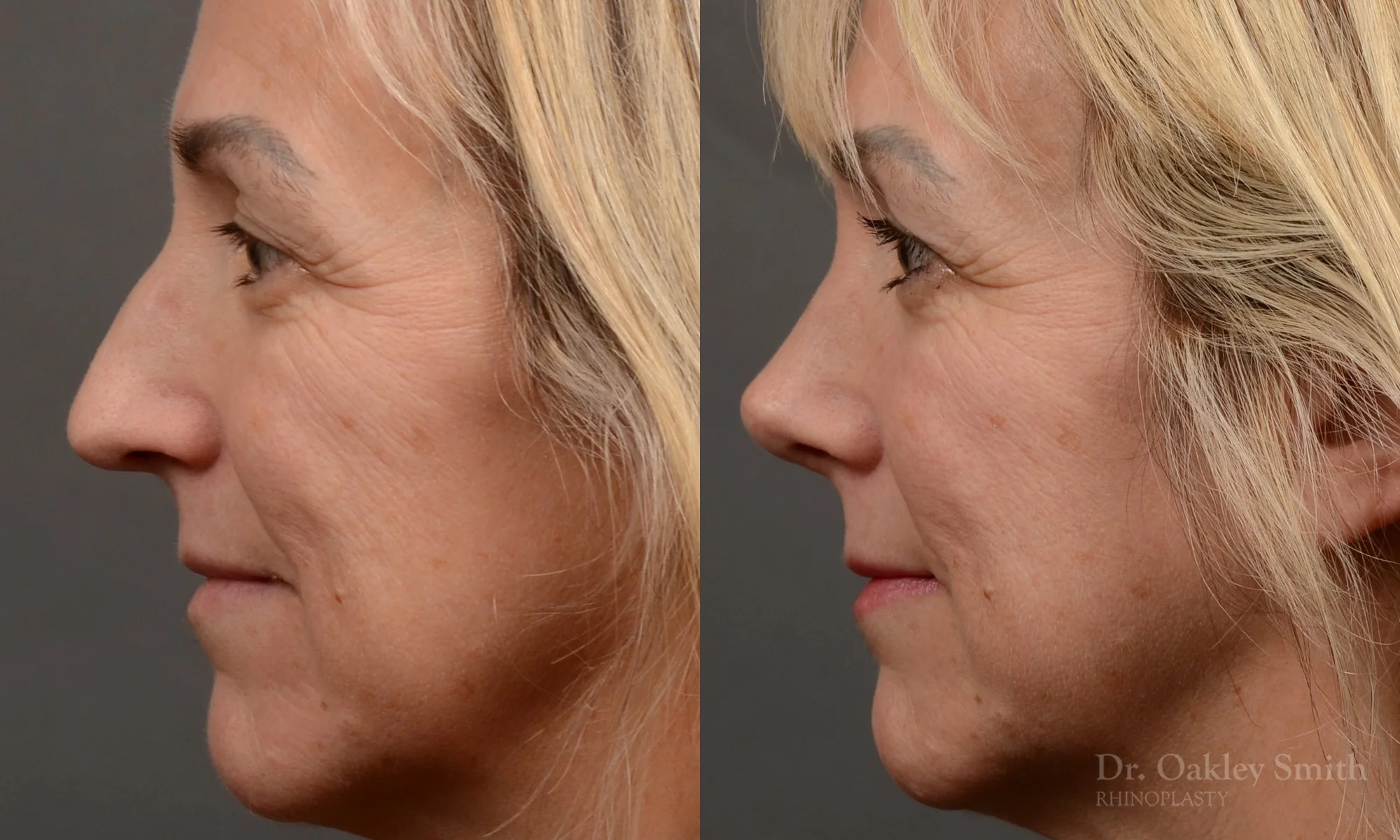 510E-rhinoplasty-dr-oakley-smith-toronto-top-surgeon-nose-job.jpg