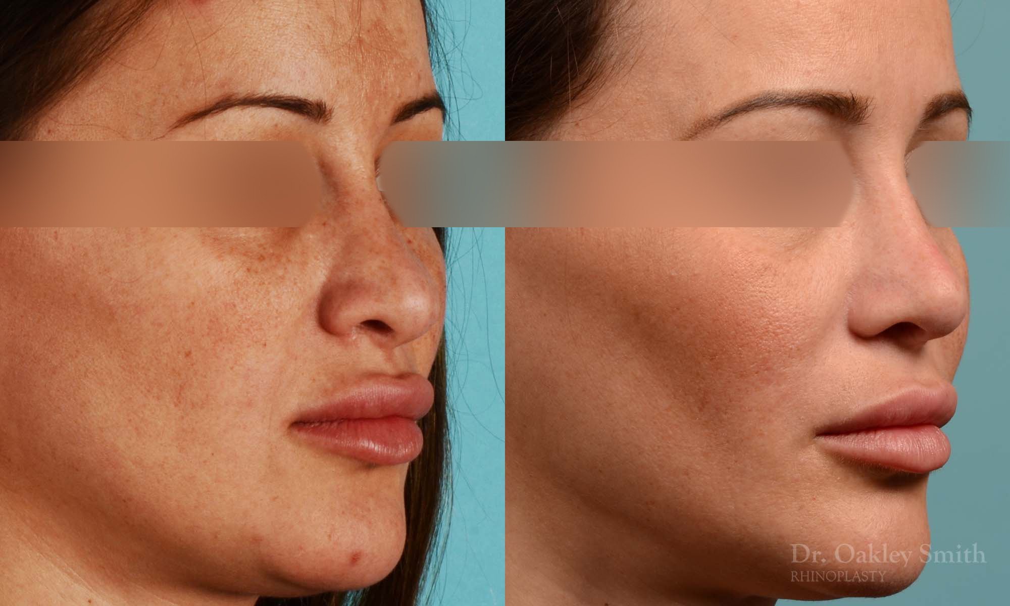 258B-rhinoplasty-dr-oakley-smith-toronto-nose-job.jpg